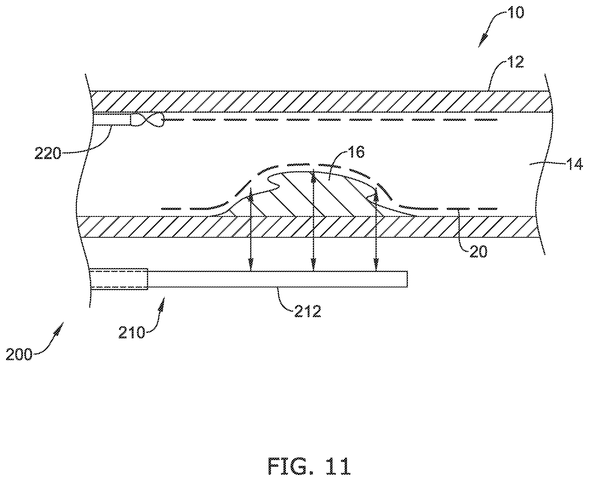 Patent US12137970 Figure 16 – Devices and methods for inducing ablation in or around occluded implants