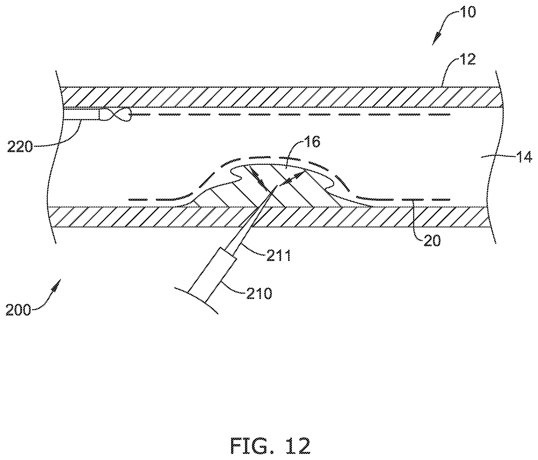 Patent US12137970 Figure 17 – Devices and methods for inducing ablation in or around occluded implants
