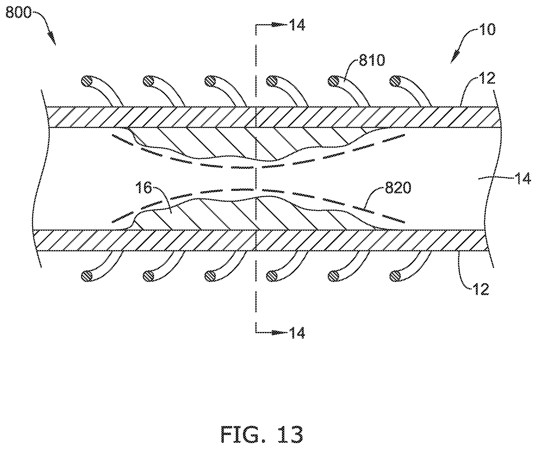 Patent US12137970 Figure 18 – Devices and methods for inducing ablation in or around occluded implants