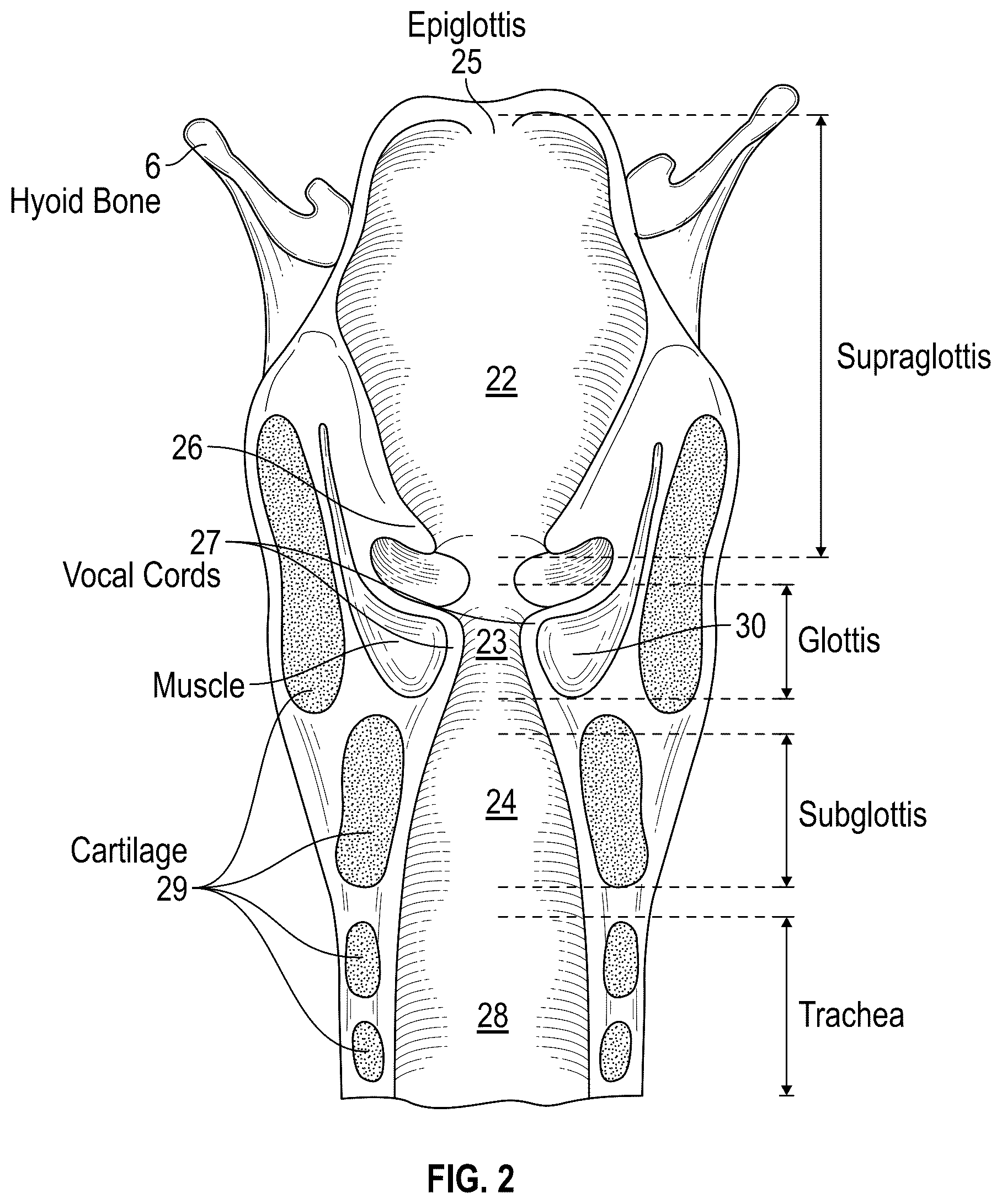 Patent US12137973 Figure 2 – Apparatus and techniques for surgical laser delivery