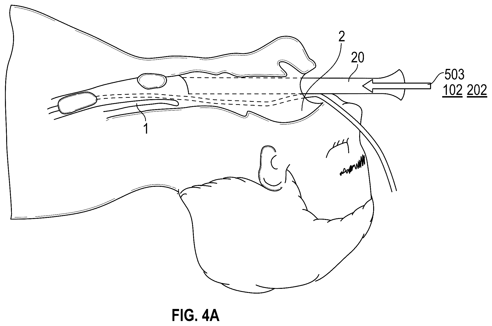 Patent US12137973 Figure 4 – Apparatus and techniques for surgical laser delivery