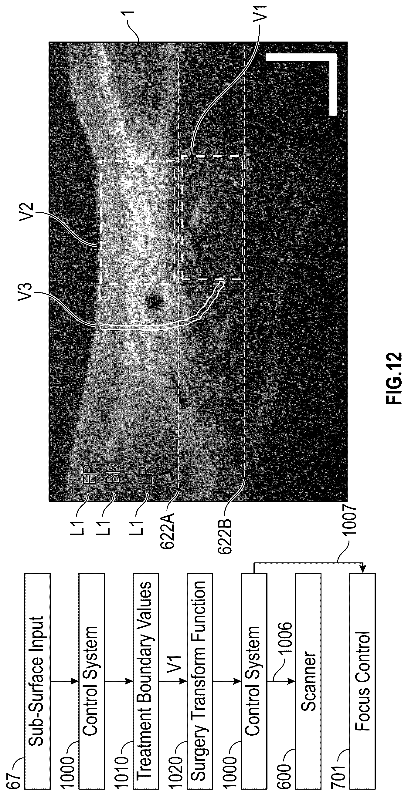 Patent US12137973 Figure 18 – Apparatus and techniques for surgical laser delivery