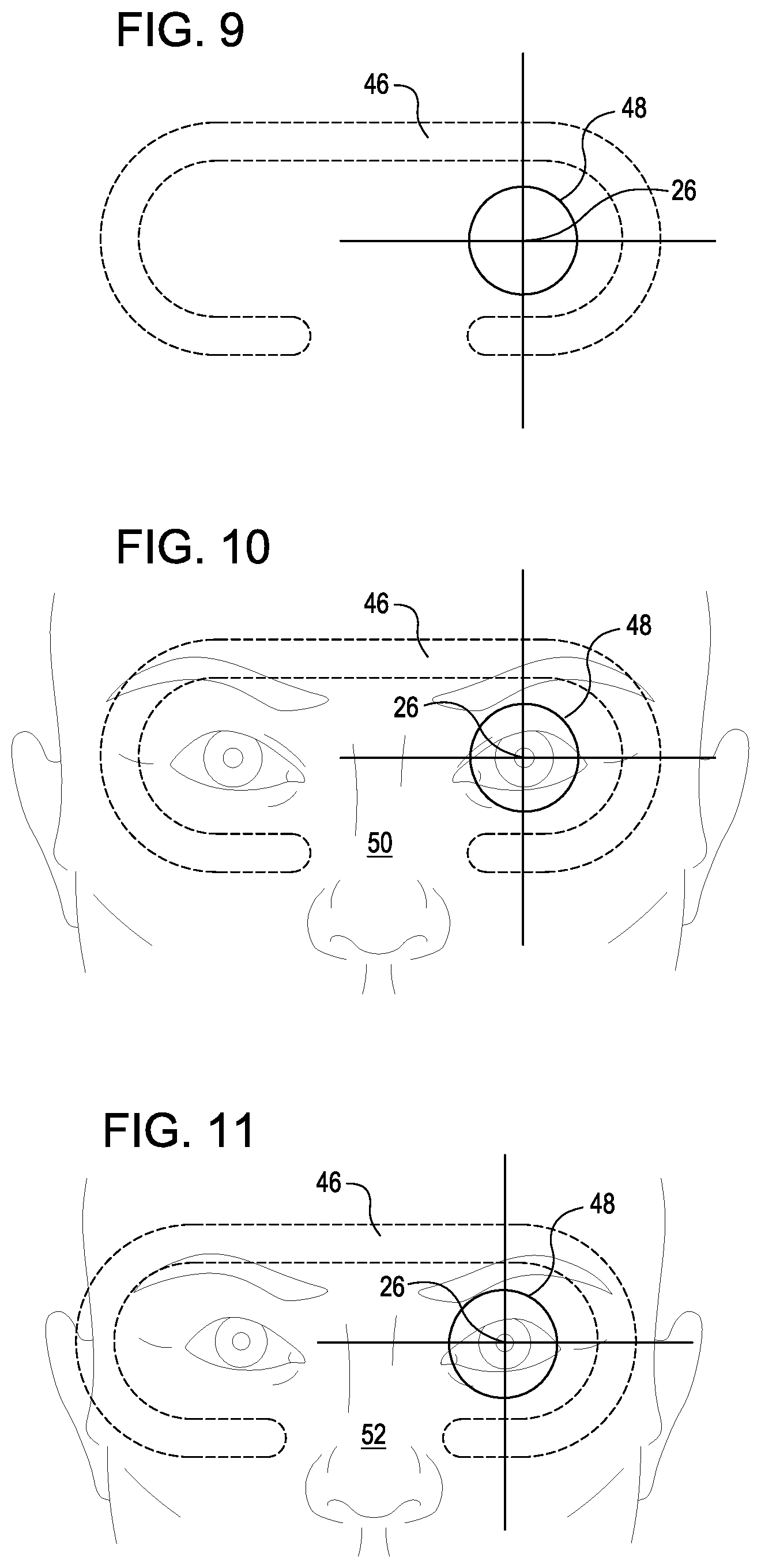 Patent US12137977 Figure 5 – Retinal imaging device and related methods