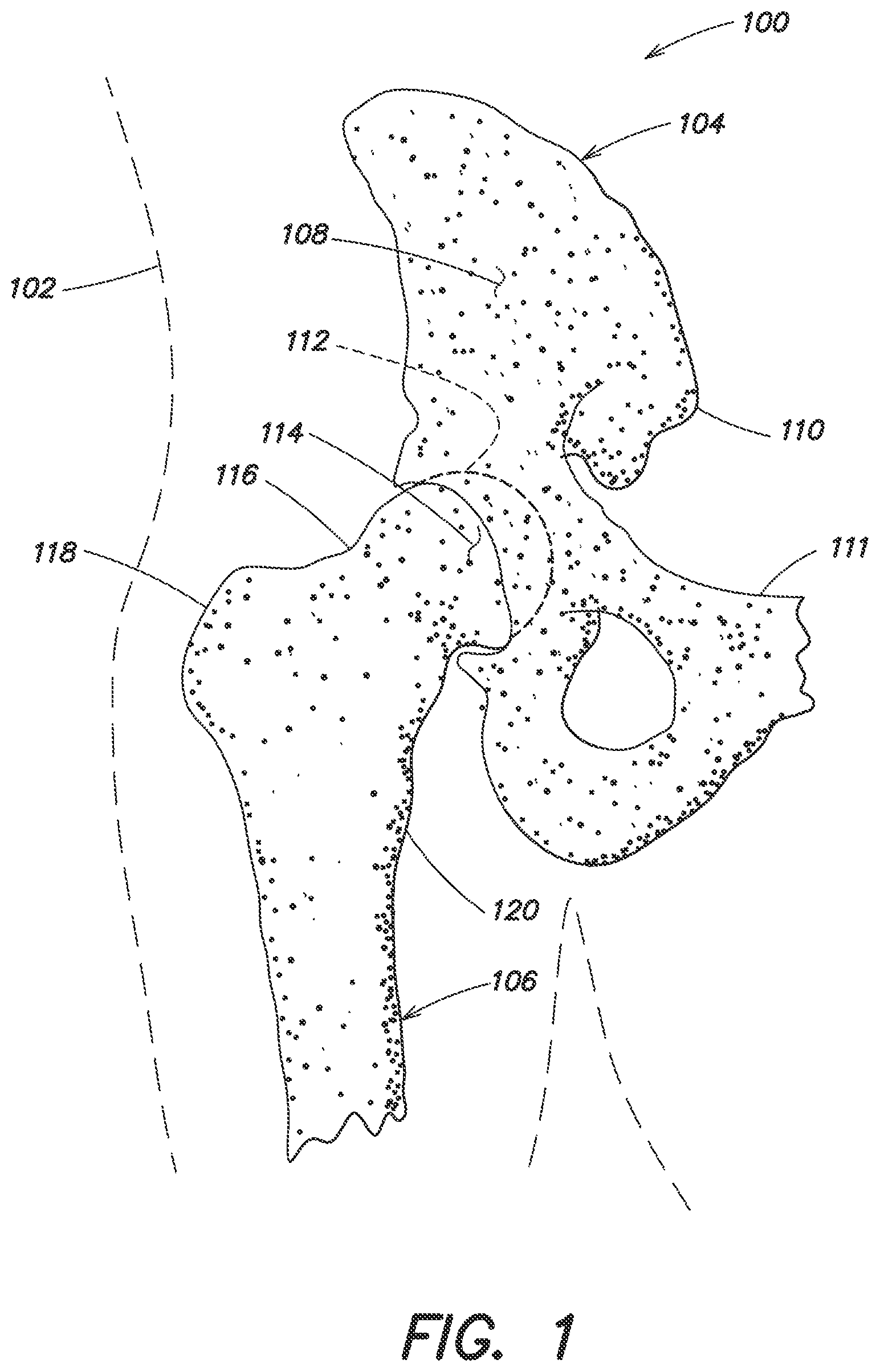 Patent US12137980 Figure 1 – Systems and methods for determining leg length change during hip surgery