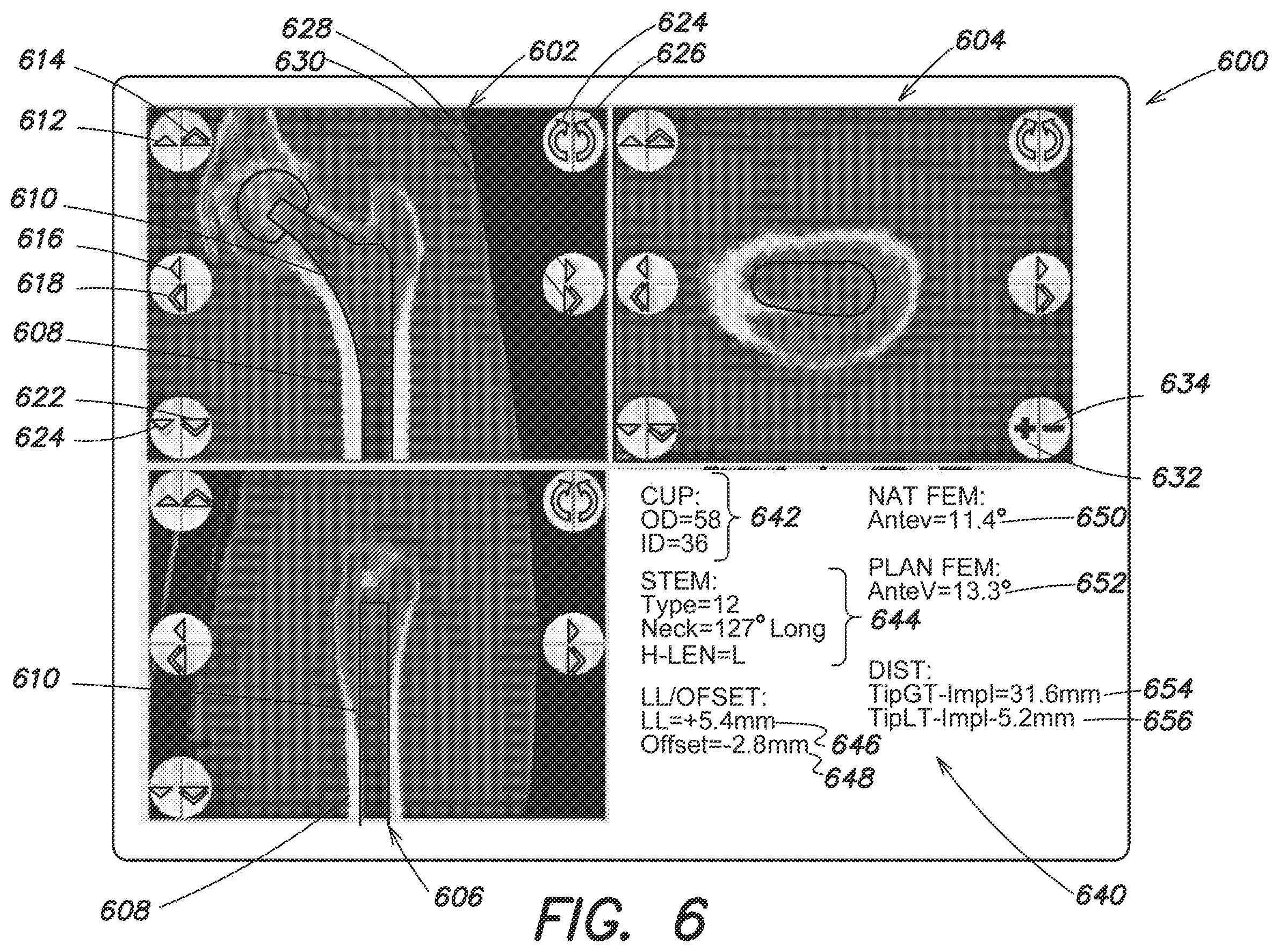 Patent US12137980 Figure 7 – Systems and methods for determining leg length change during hip surgery