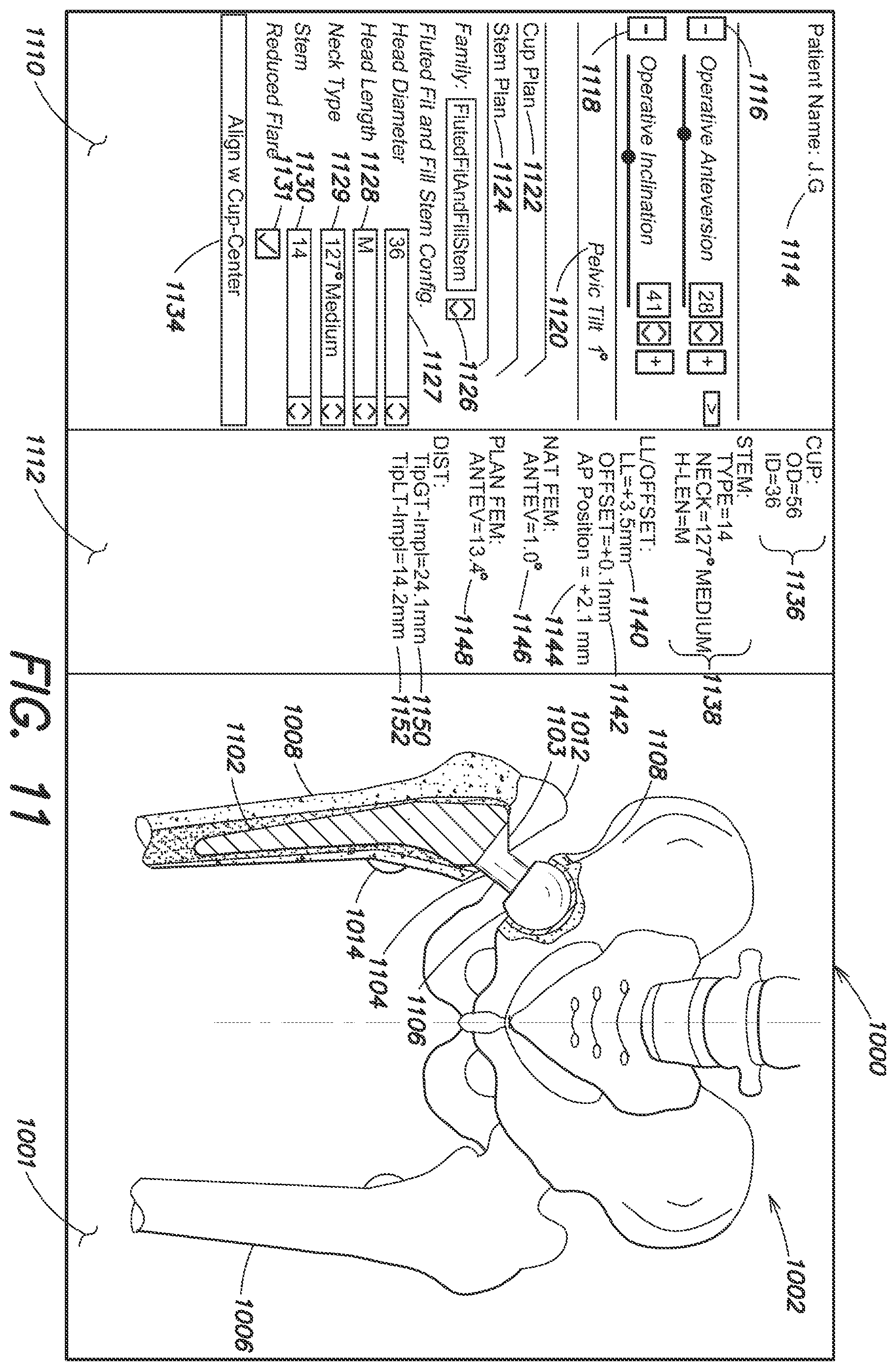 Patent US12137980 Figure 15 – Systems and methods for determining leg length change during hip surgery