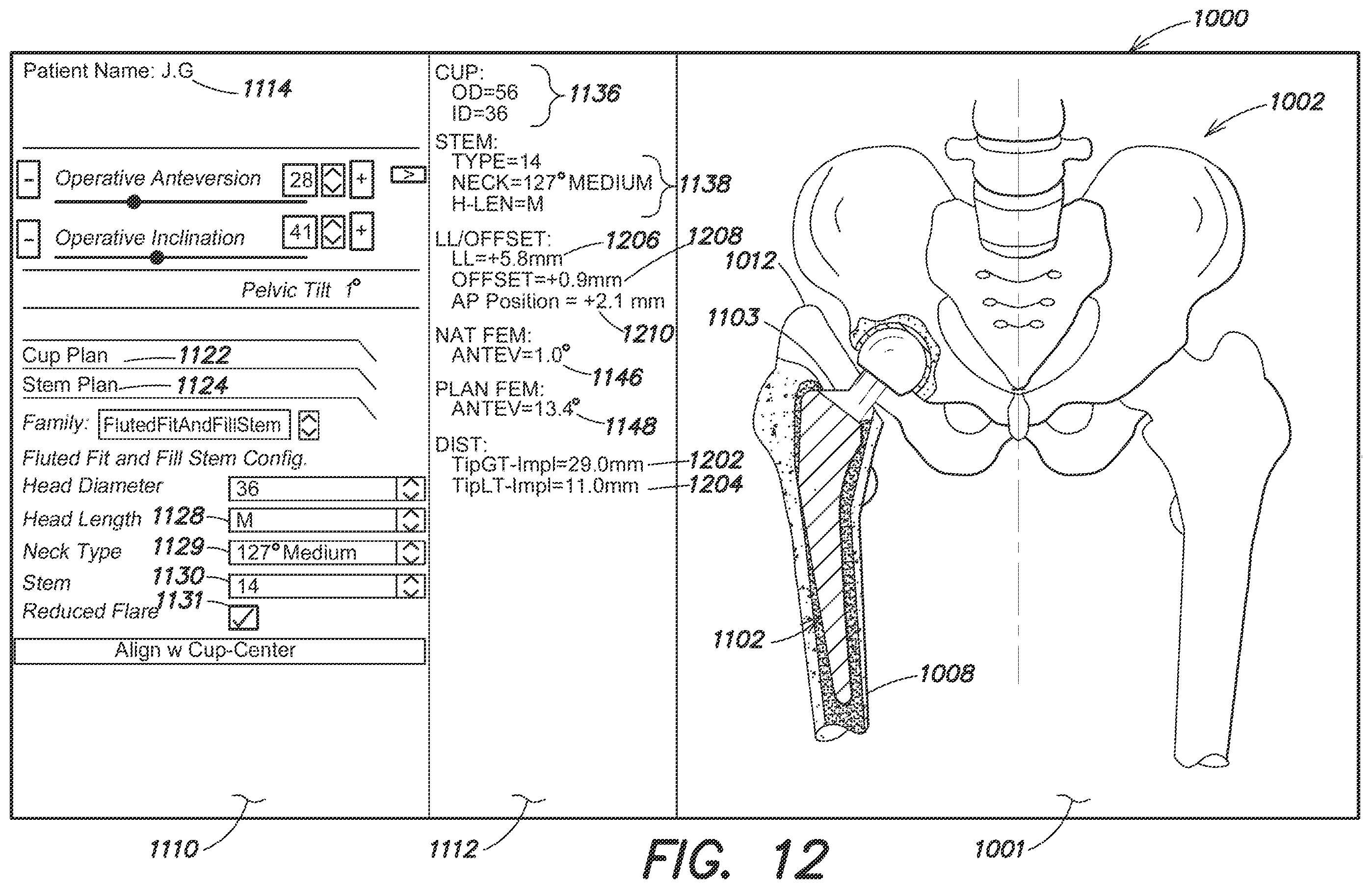 Patent US12137980 Figure 16 – Systems and methods for determining leg length change during hip surgery