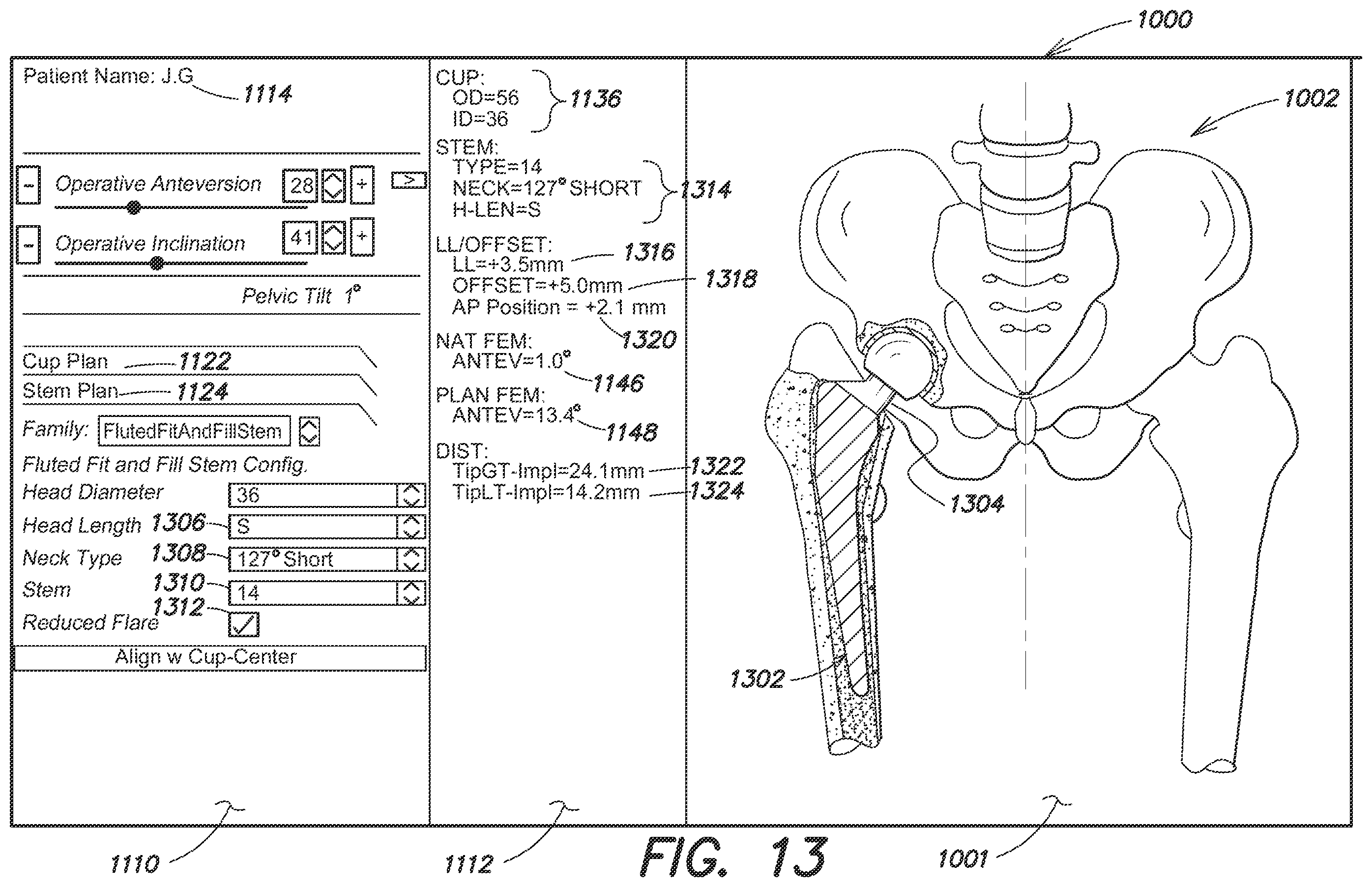 Patent US12137980 Figure 17 – Systems and methods for determining leg length change during hip surgery