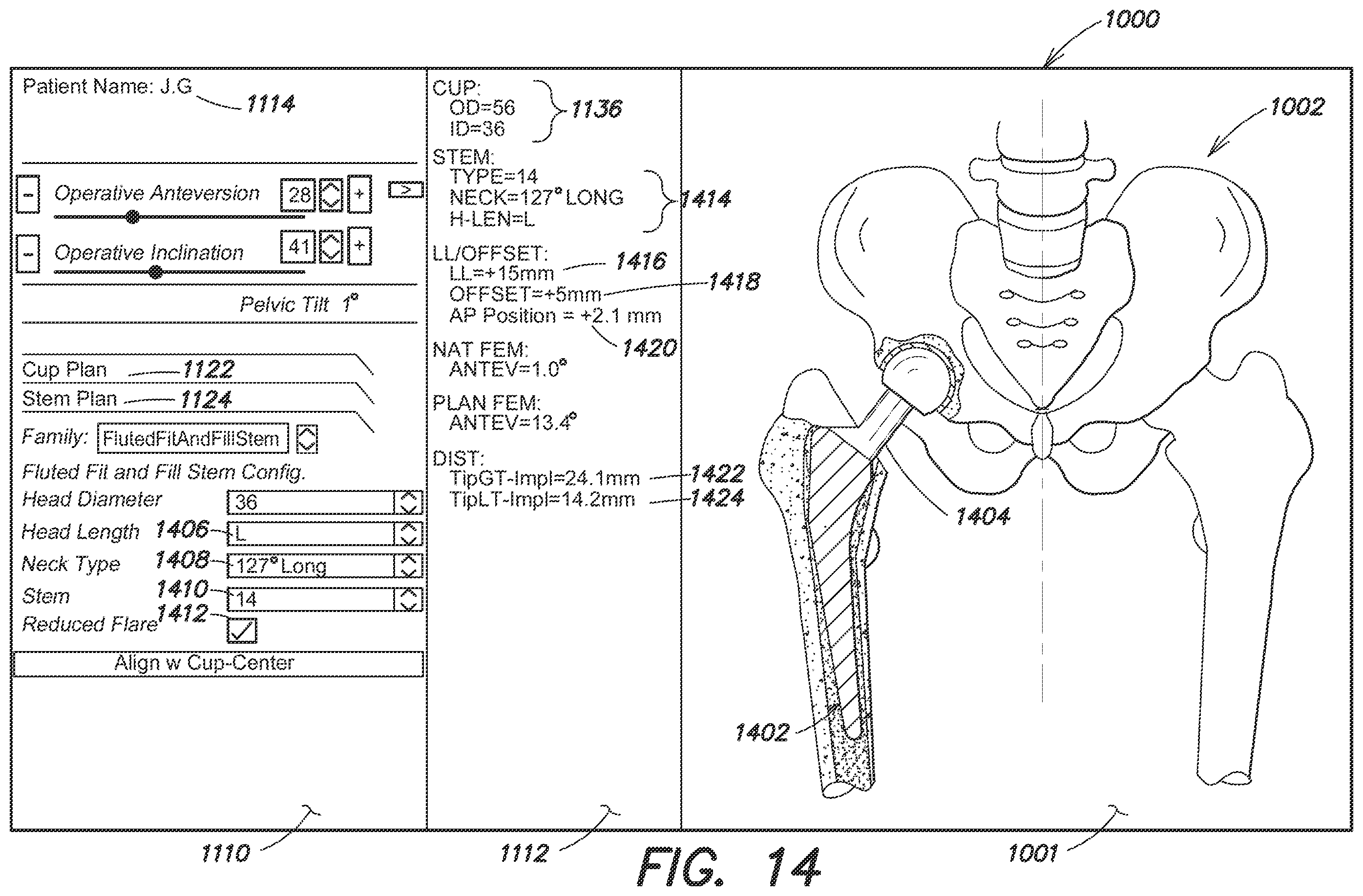 Patent US12137980 Figure 18 – Systems and methods for determining leg length change during hip surgery