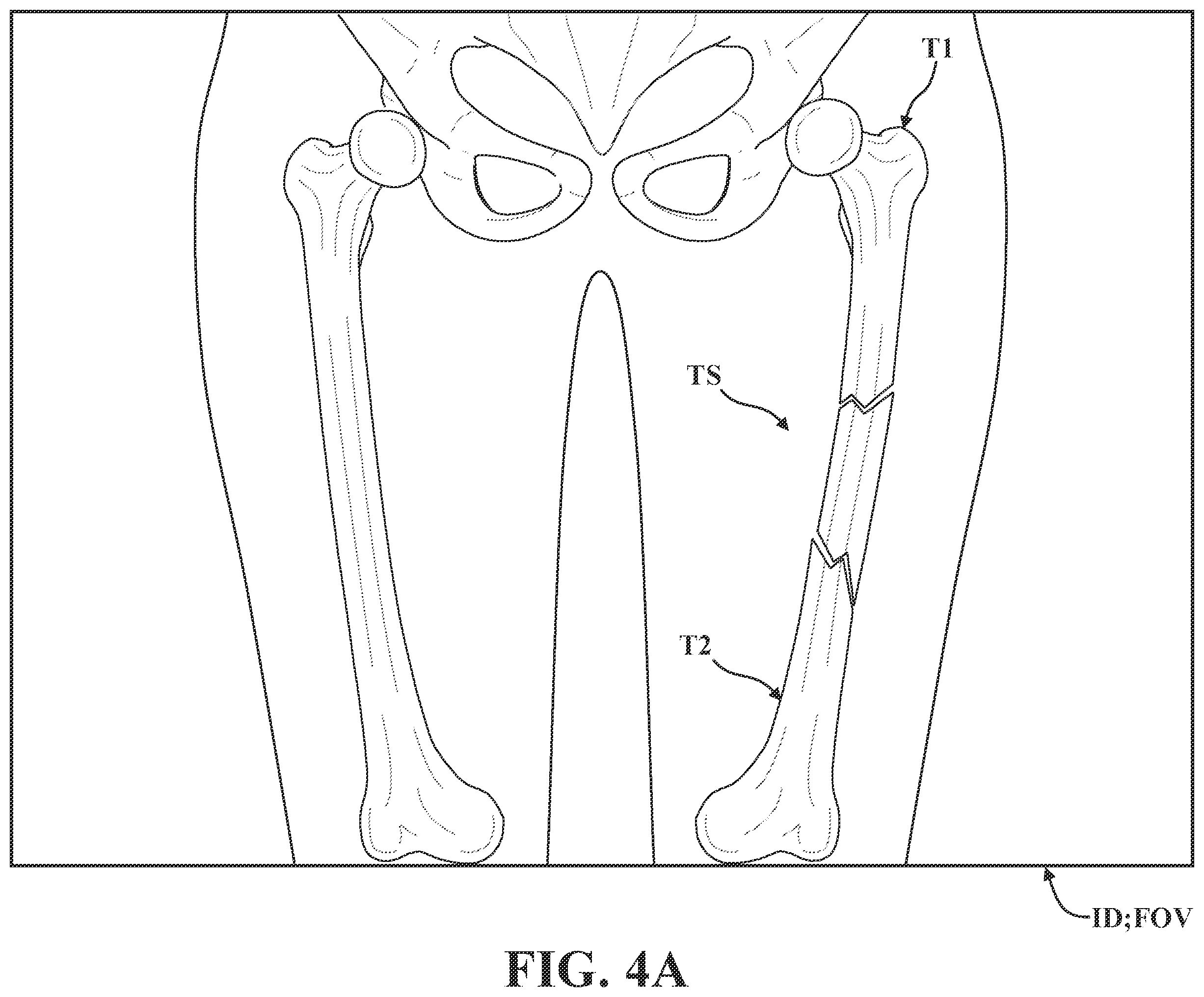 Patent US12137981 Figure 6 – Surgical systems and methods for facilitating tissue treatment