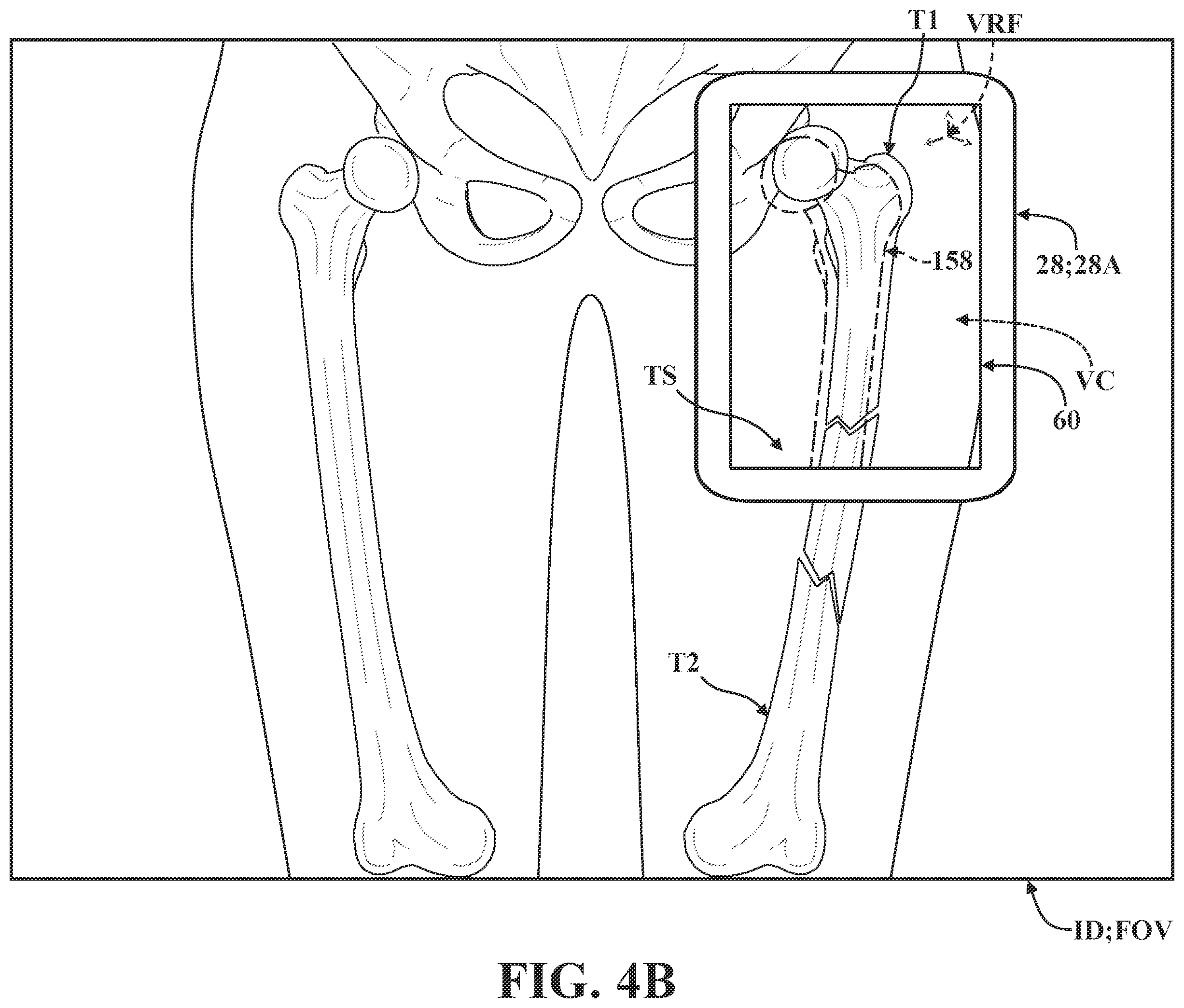 Patent US12137981 Figure 7 – Surgical systems and methods for facilitating tissue treatment