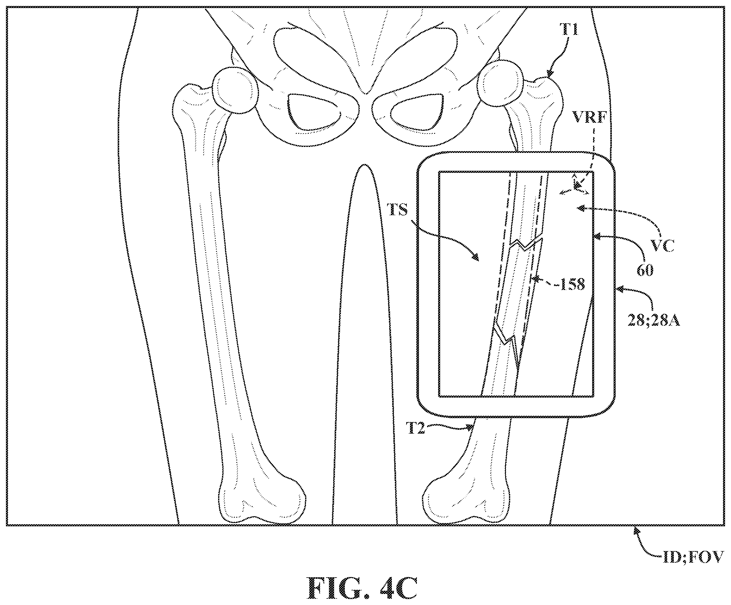 Patent US12137981 Figure 8 – Surgical systems and methods for facilitating tissue treatment