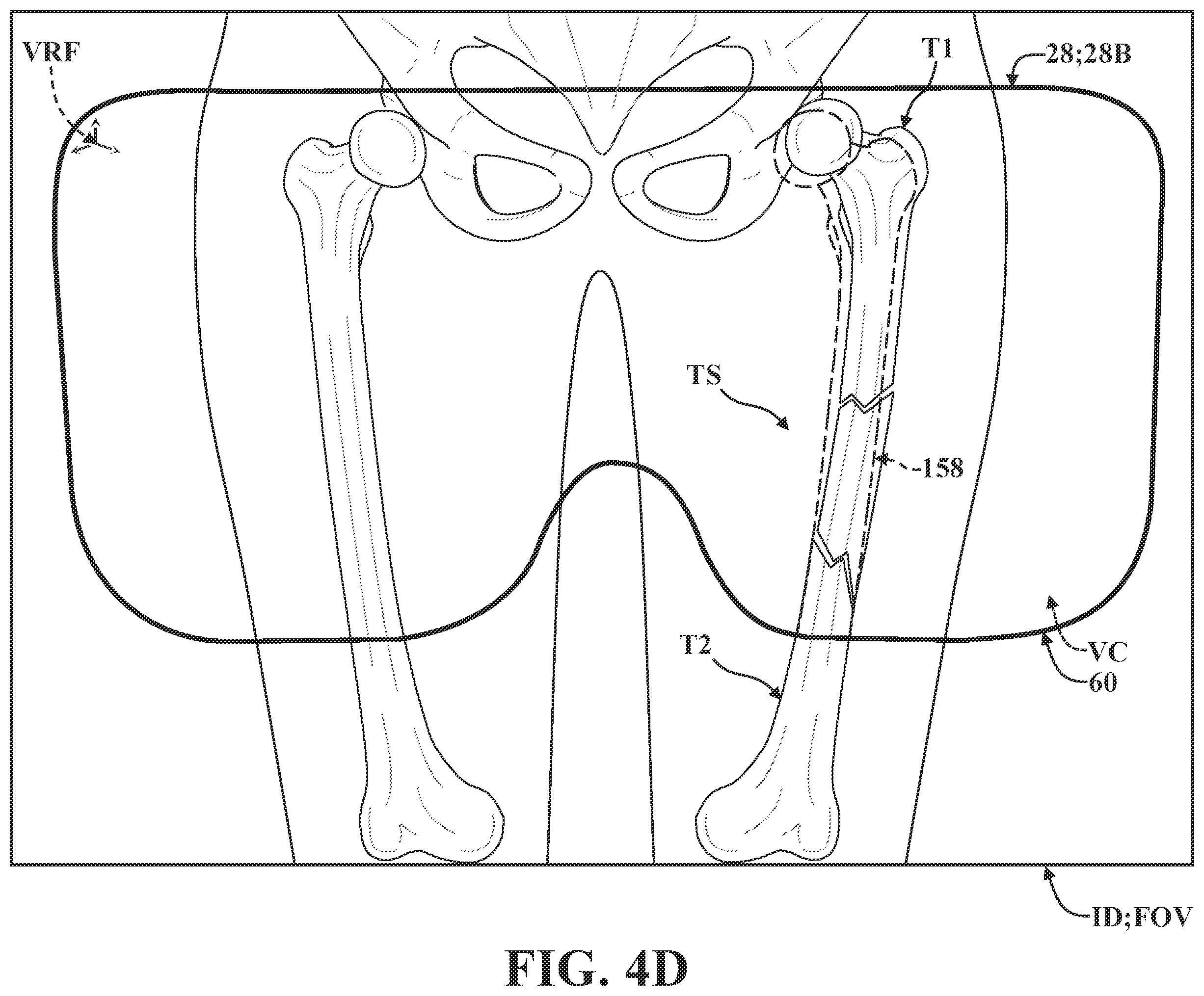 Patent US12137981 Figure 9 – Surgical systems and methods for facilitating tissue treatment