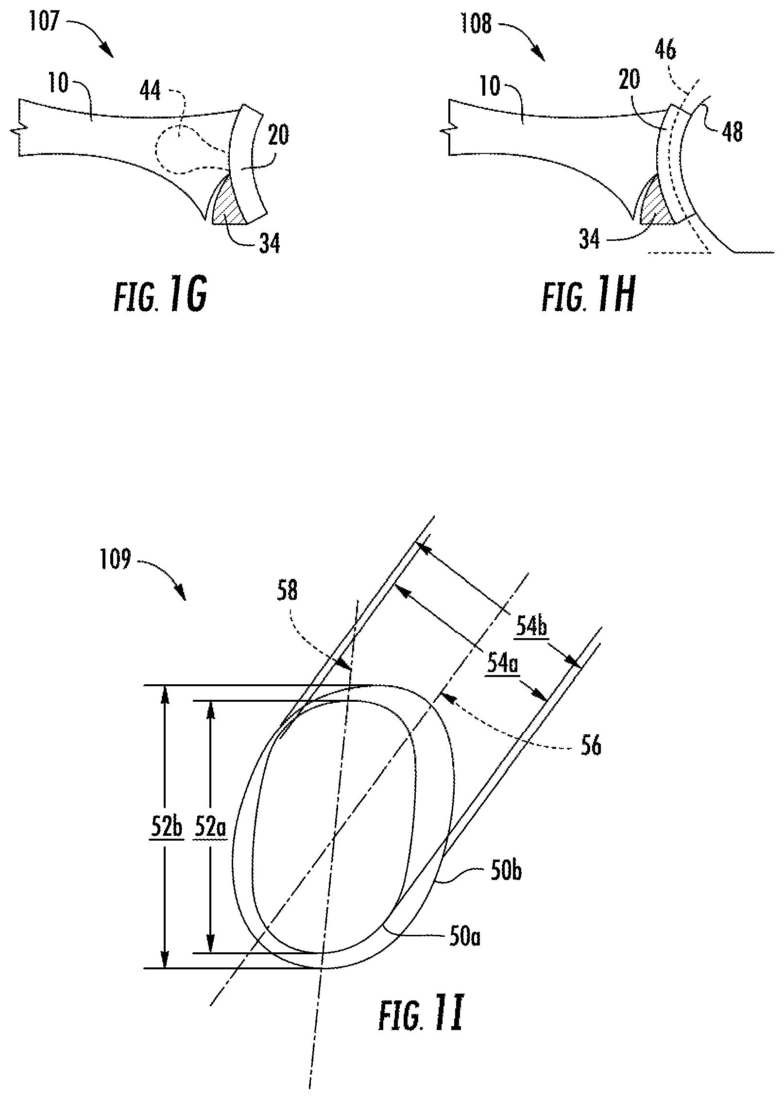 Patent US12137982 Figure 2 – Methods, systems and devices for pre-operatively planned shoulder surgery guides and implants
