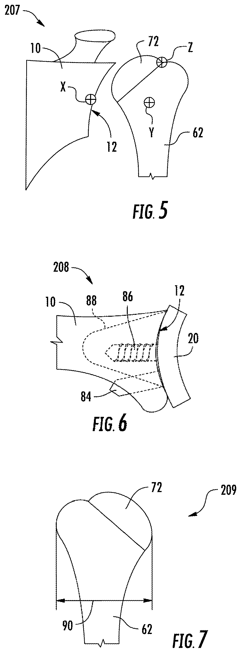 Patent US12137982 Figure 4 – Methods, systems and devices for pre-operatively planned shoulder surgery guides and implants