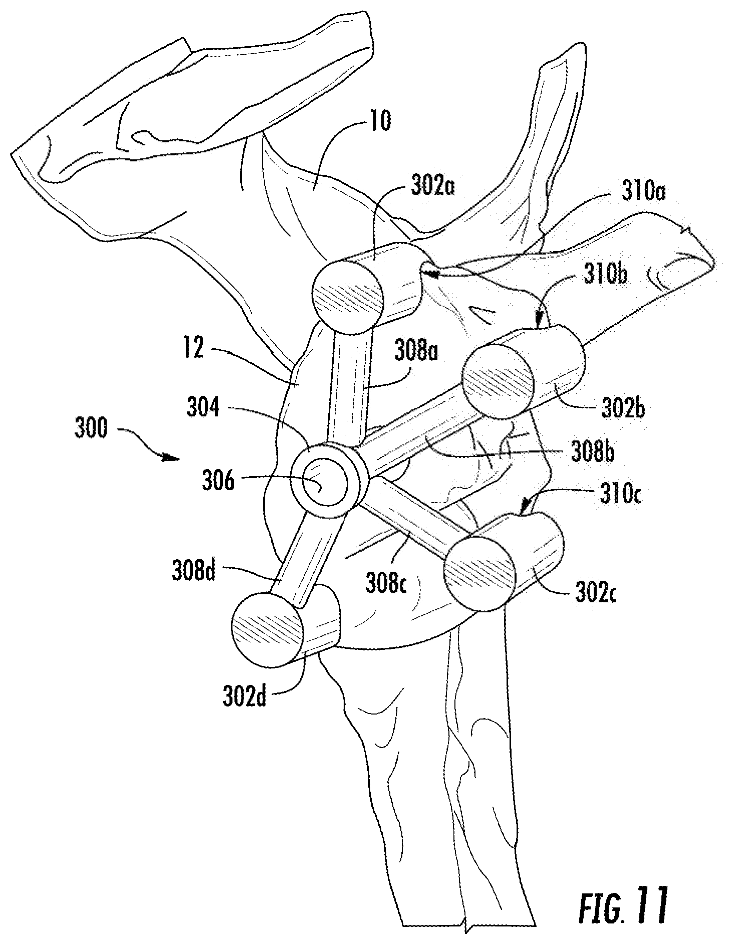 Patent US12137982 Figure 7 – Methods, systems and devices for pre-operatively planned shoulder surgery guides and implants