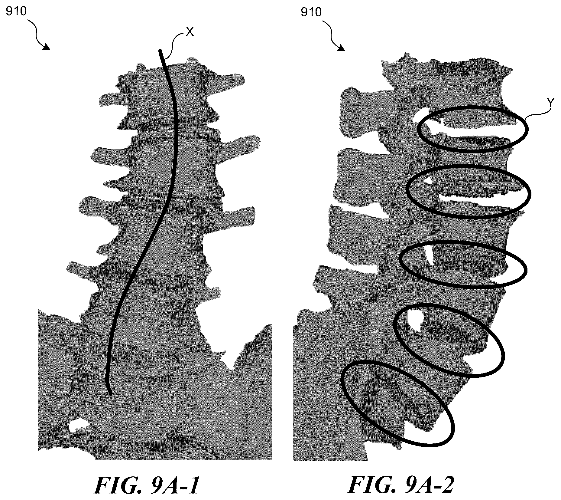 Patent US12137983 Figure 13 – Patient-specific medical systems, devices, and methods