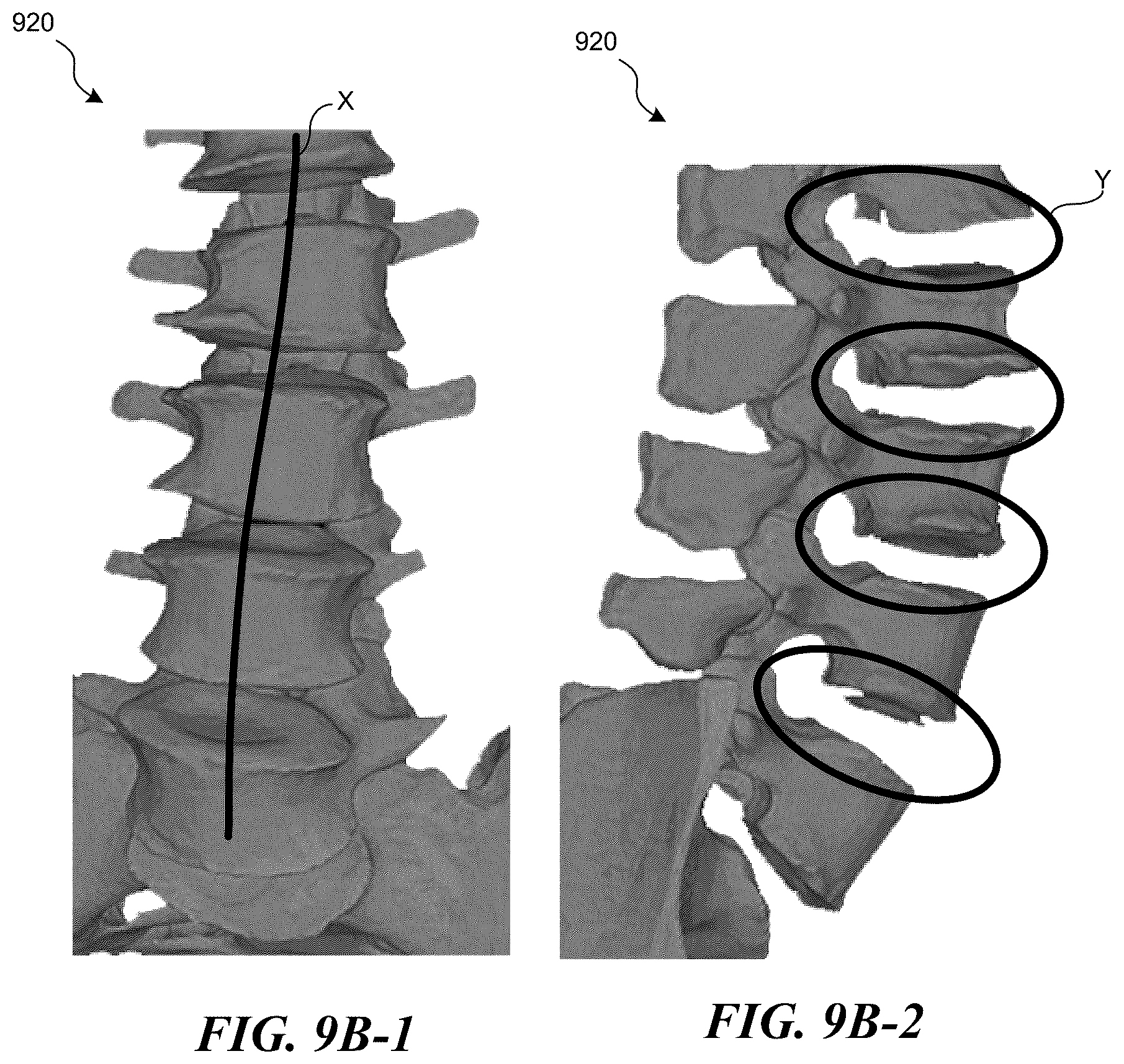 Patent US12137983 Figure 14 – Patient-specific medical systems, devices, and methods