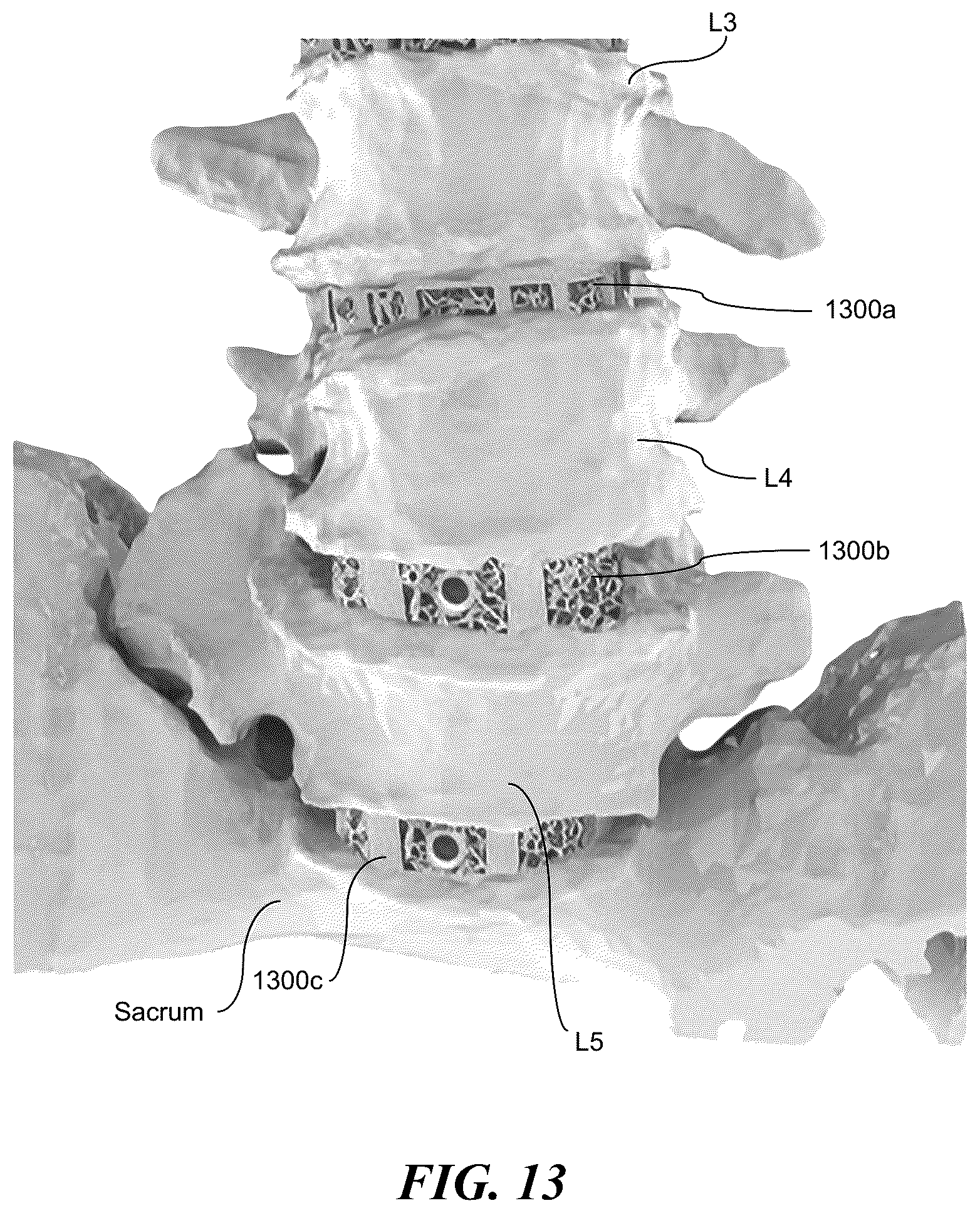 Patent US12137983 Figure 18 – Patient-specific medical systems, devices, and methods