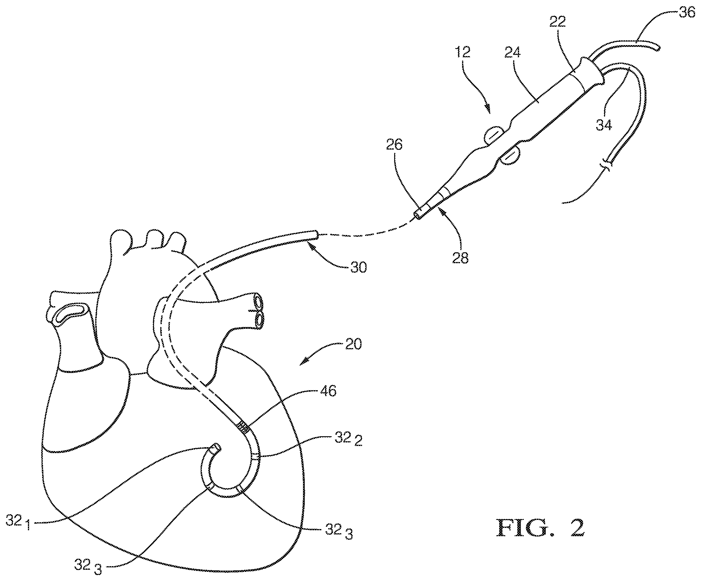 Patent US12137988 Figure 2 – System and method for noise tolerant cardiac localization, navigation and mapping