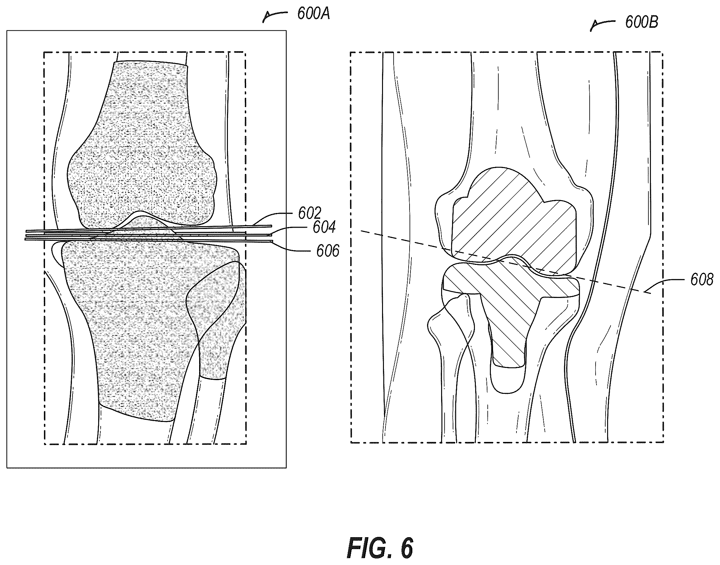 Patent US12137996 Figure 9 – Revision robotics