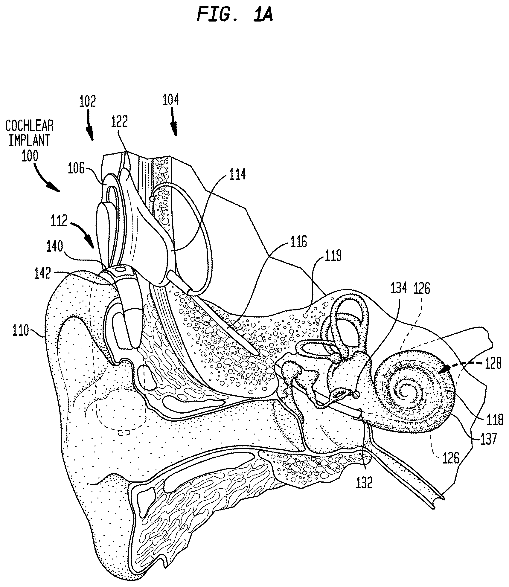 Patent US12155983 Figure 1 – Contaminant-proof microphone assembly