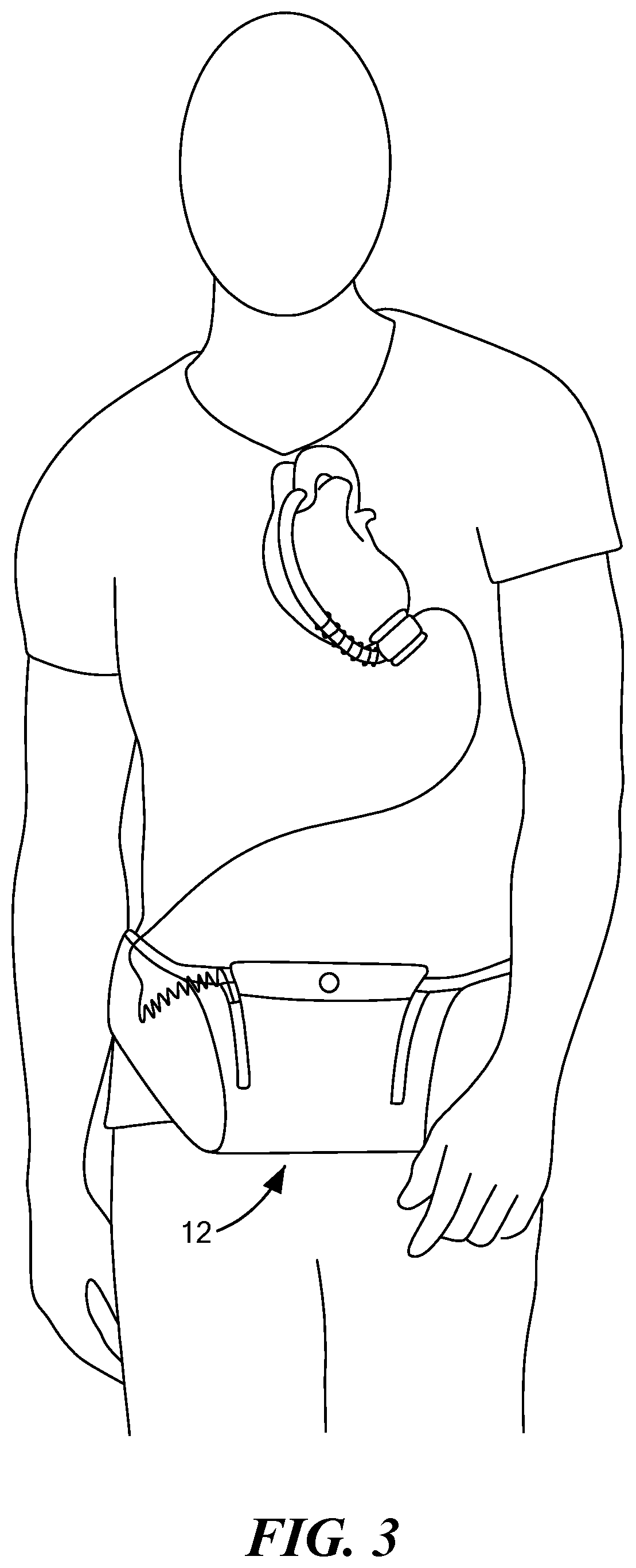 Patent US12157000 Figure 3 – Carrying case for controller of patients with VADs