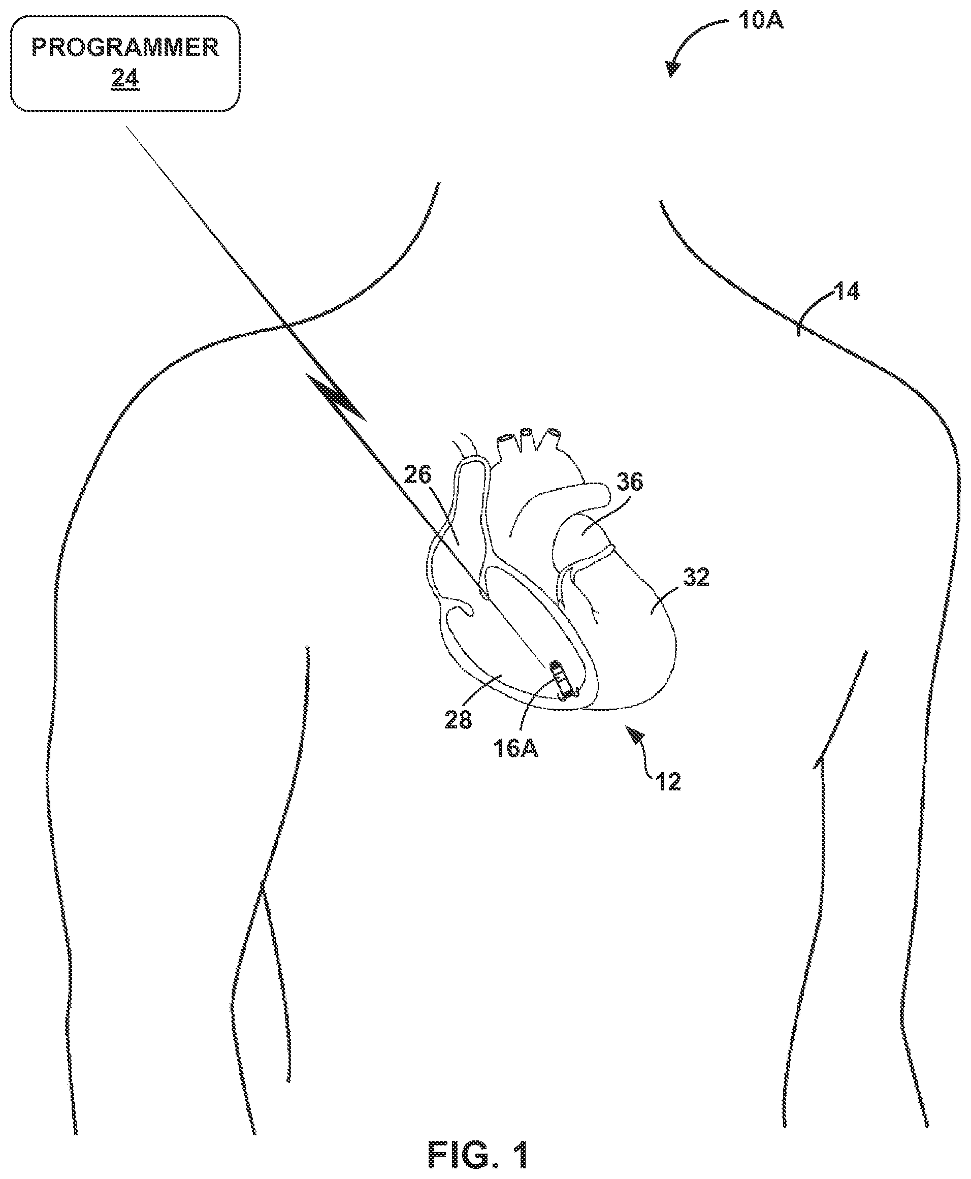 Patent US12157003 Figure 1 – Implantable medical device fixation