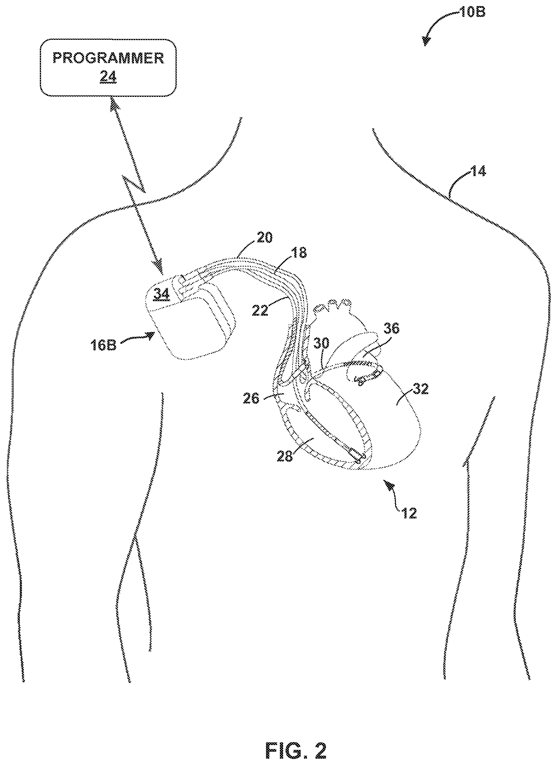 Patent US12157003 Figure 2 – Implantable medical device fixation