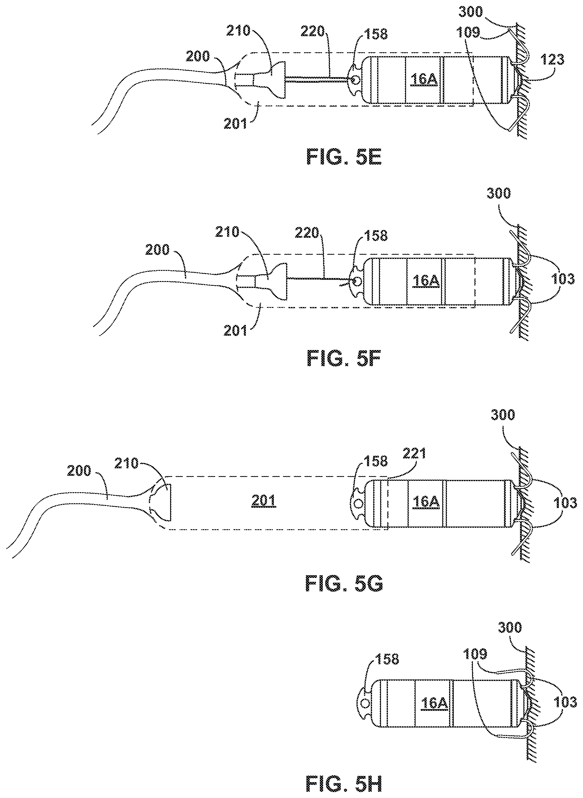 Patent US12157003 Figure 6 – Implantable medical device fixation