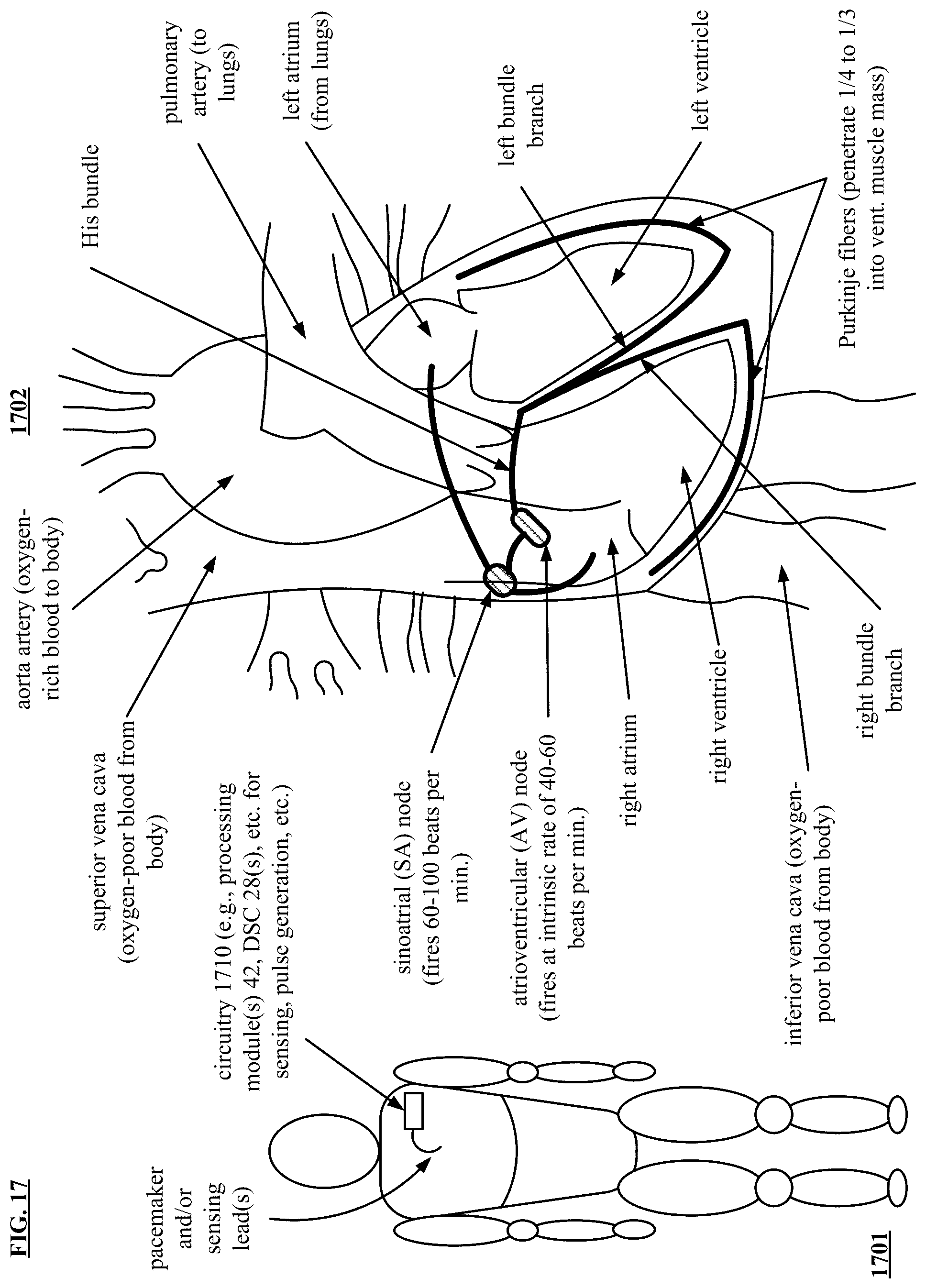 Patent US12157004 Figure 16 – Noninvasive heart and/or intrathoracic impedance sensor