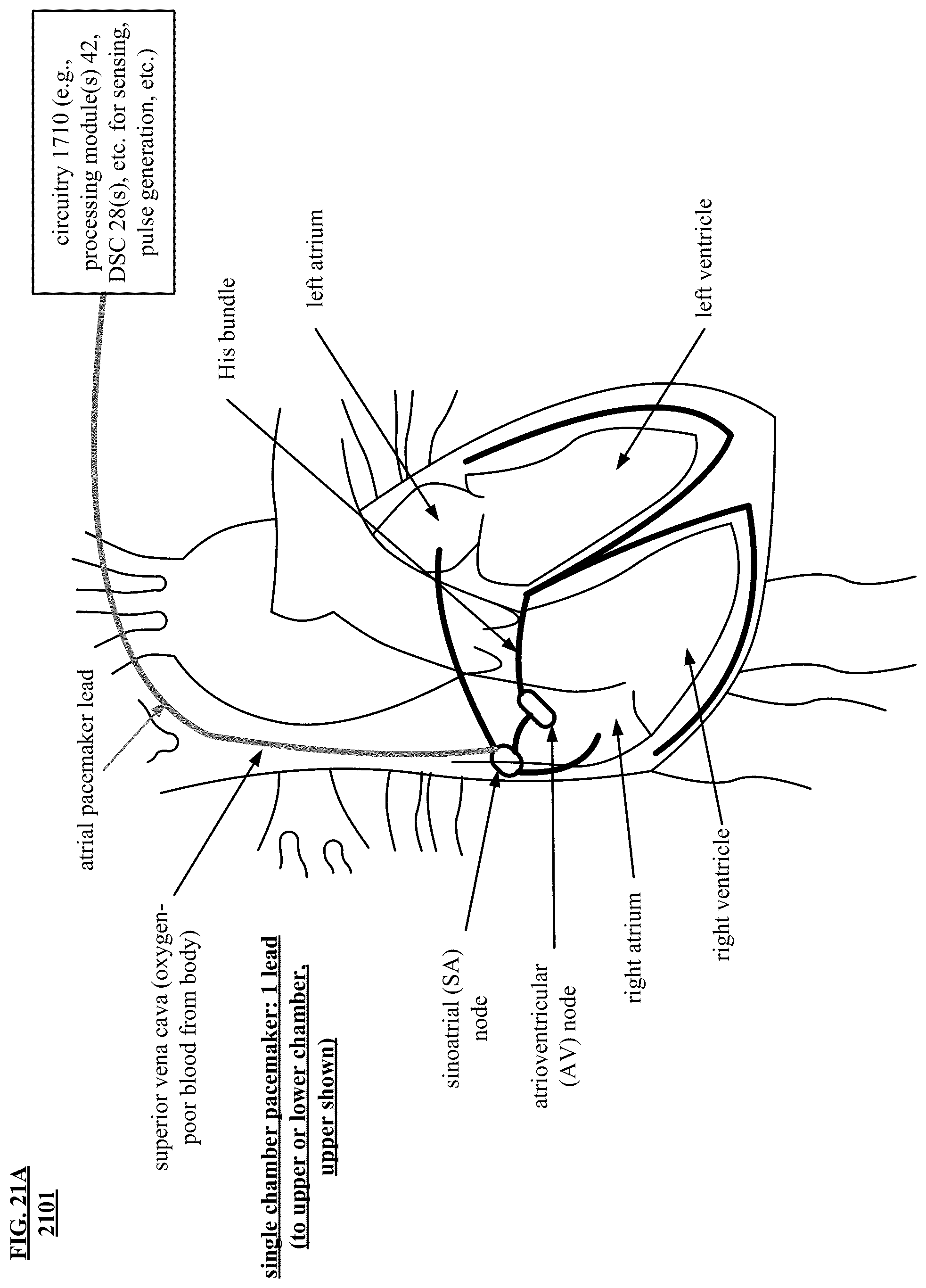 Patent US12157004 Figure 20 – Noninvasive heart and/or intrathoracic impedance sensor