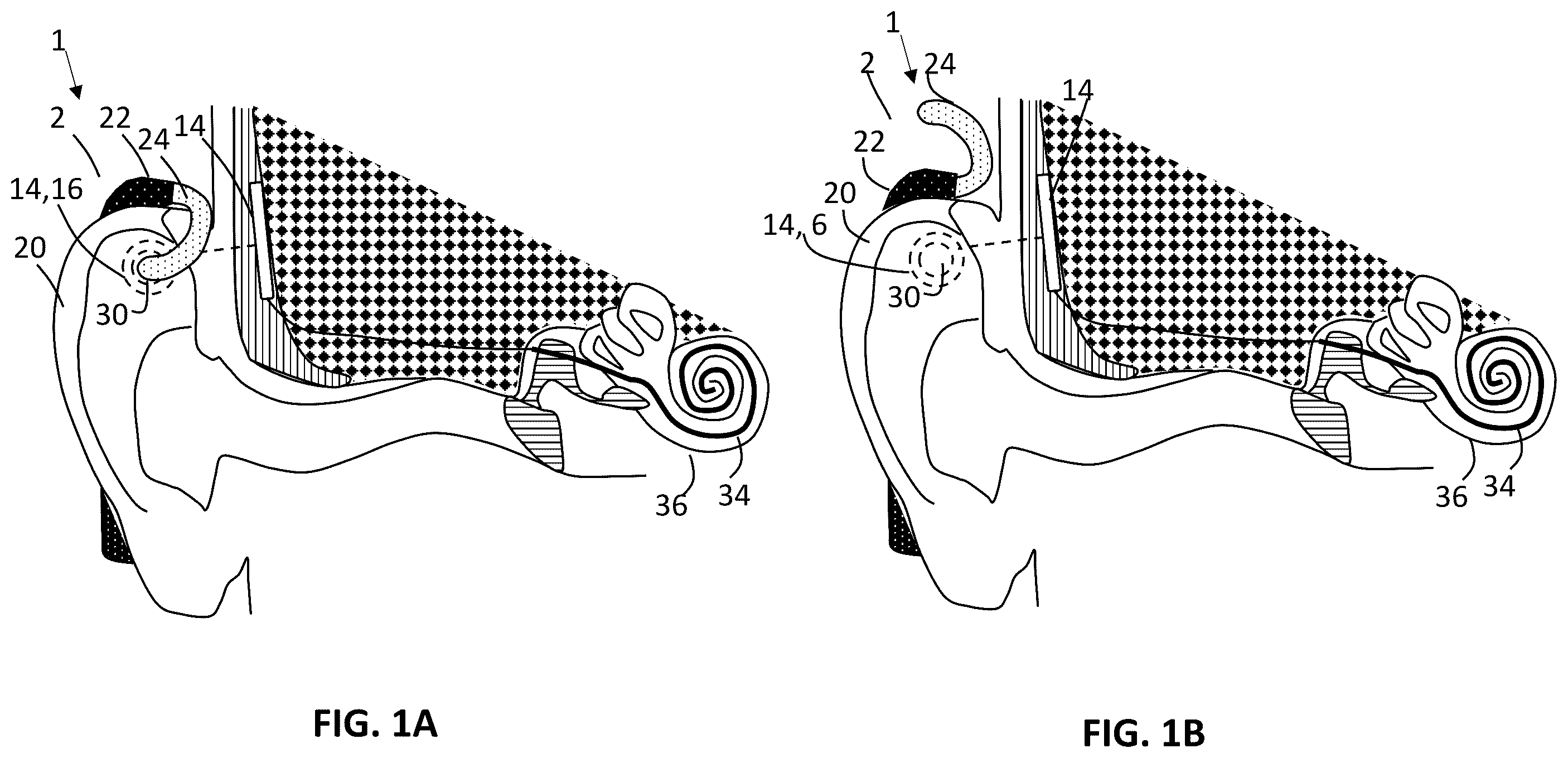 Patent US12157006 Figure 1 – Implantable hearing aid system comprising a wireless transcutaneous link