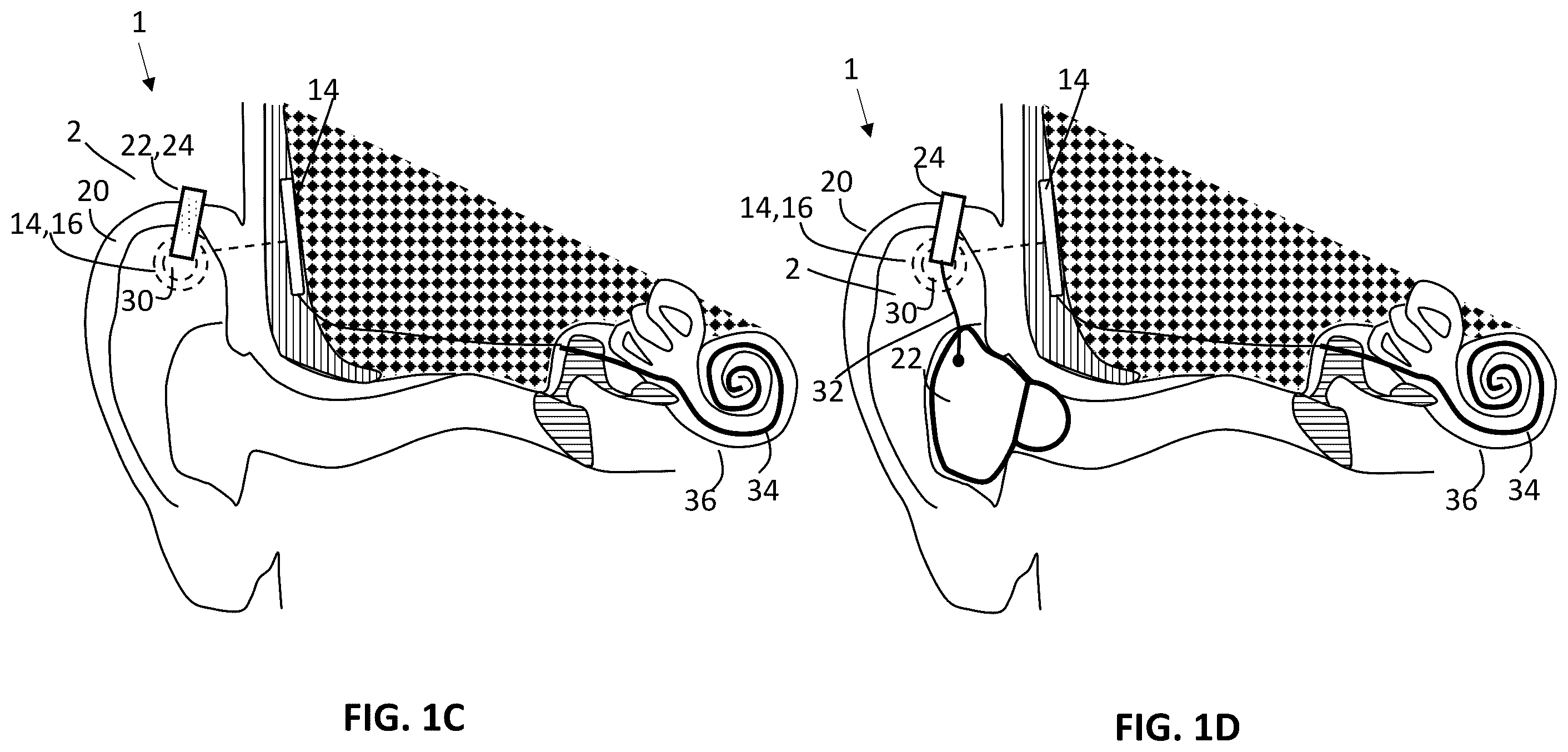 Patent US12157006 Figure 2 – Implantable hearing aid system comprising a wireless transcutaneous link