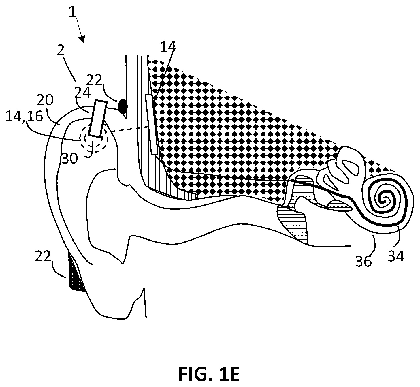 Patent US12157006 Figure 3 – Implantable hearing aid system comprising a wireless transcutaneous link