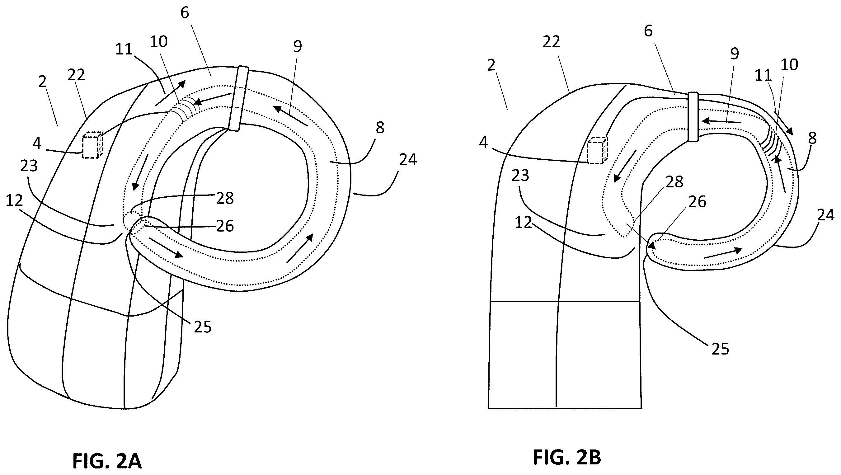 Patent US12157006 Figure 4 – Implantable hearing aid system comprising a wireless transcutaneous link