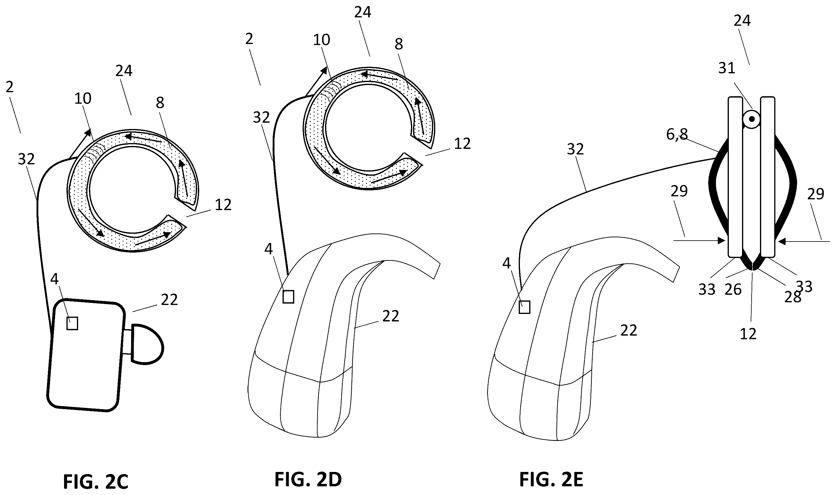Patent US12157006 Figure 5 – Implantable hearing aid system comprising a wireless transcutaneous link