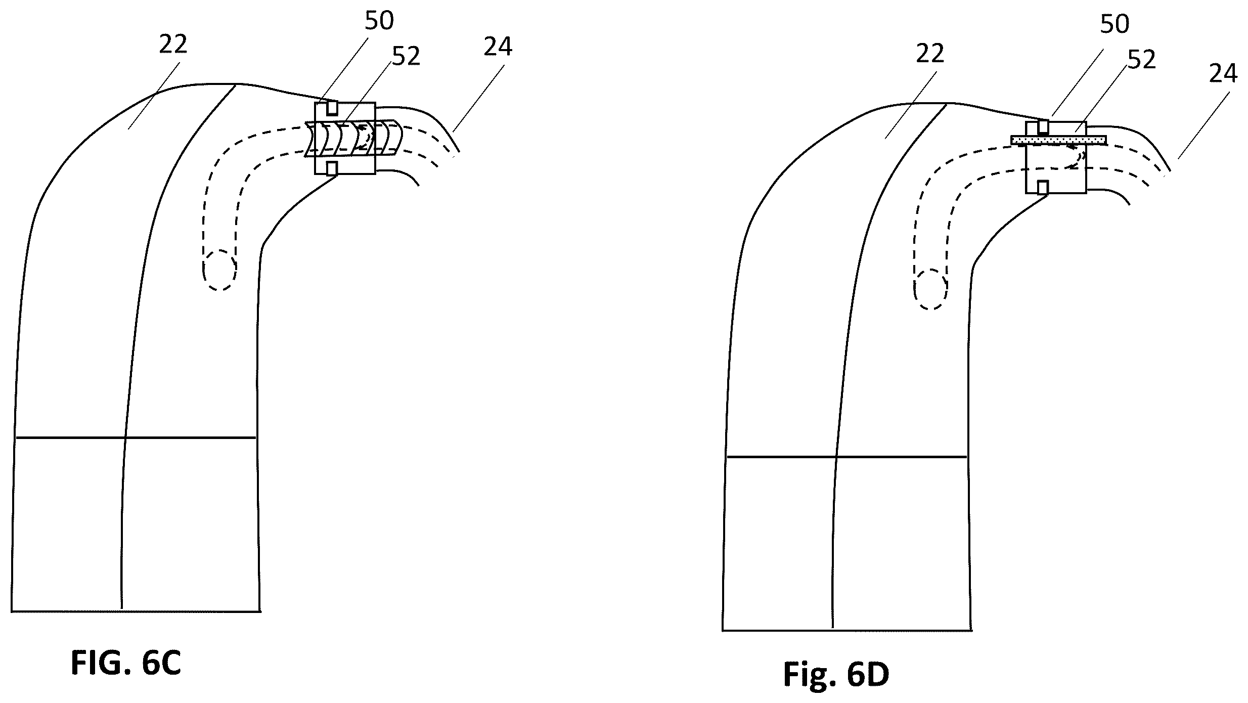 Patent US12157006 Figure 10 – Implantable hearing aid system comprising a wireless transcutaneous link