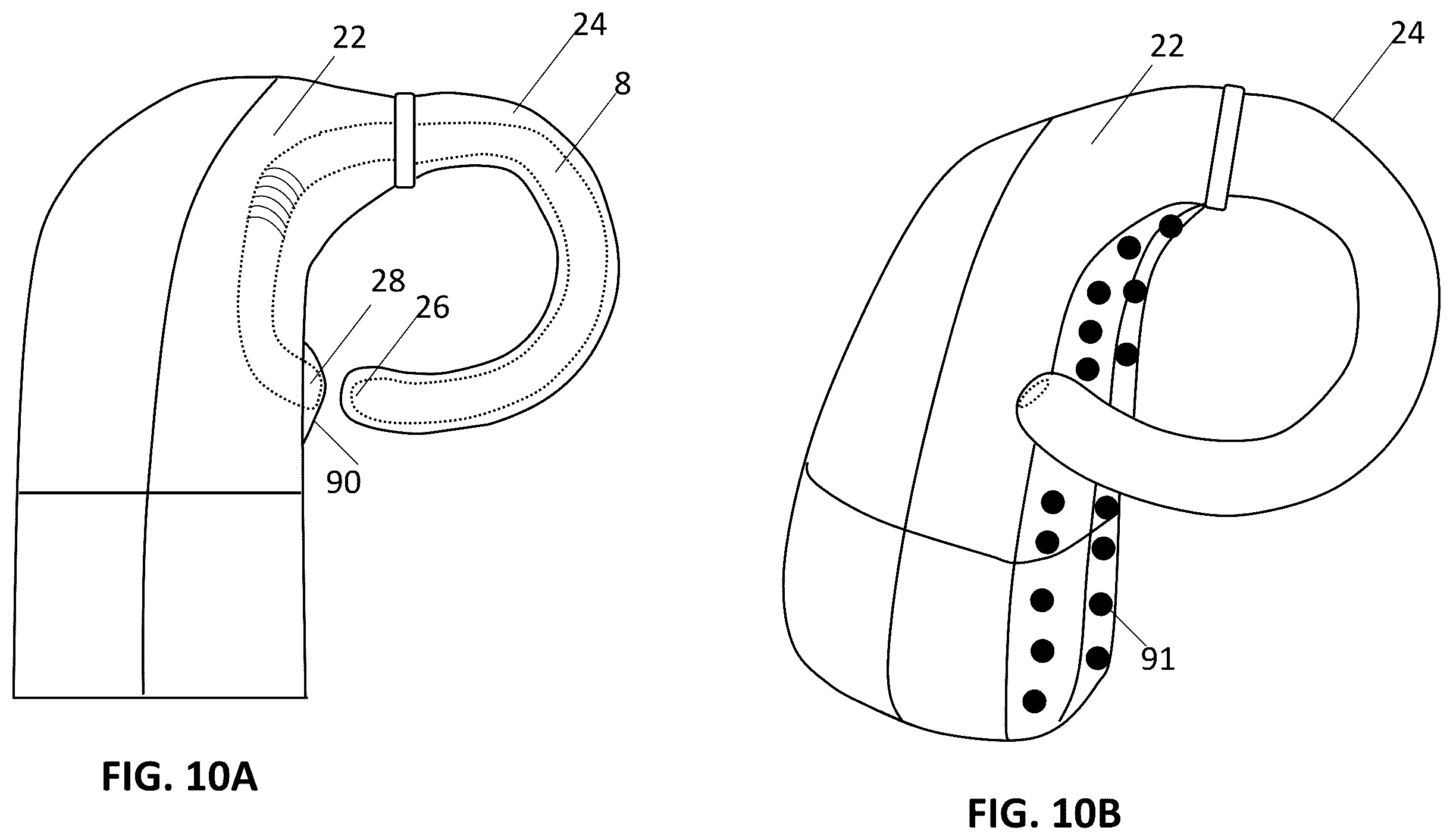 Patent US12157006 Figure 14 – Implantable hearing aid system comprising a wireless transcutaneous link