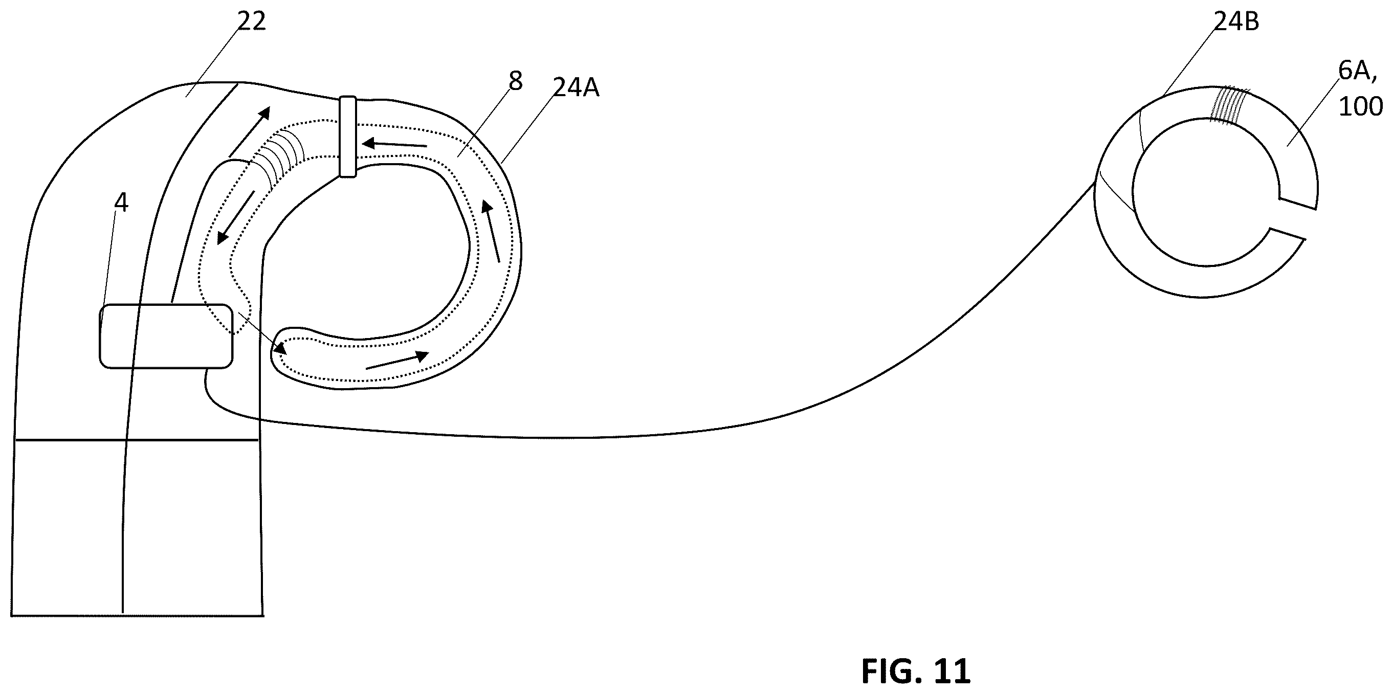 Patent US12157006 Figure 15 – Implantable hearing aid system comprising a wireless transcutaneous link