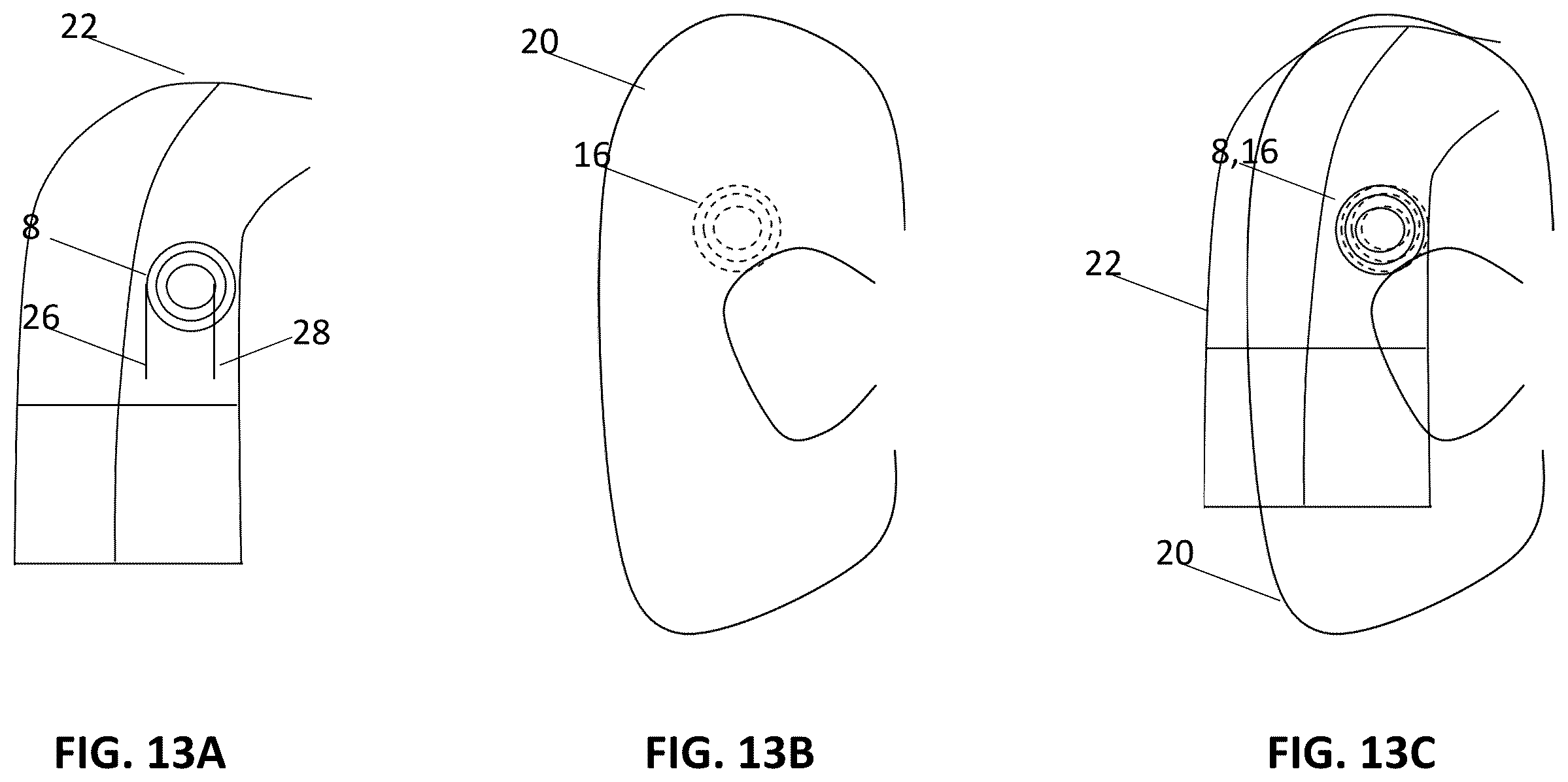 Patent US12157006 Figure 17 – Implantable hearing aid system comprising a wireless transcutaneous link
