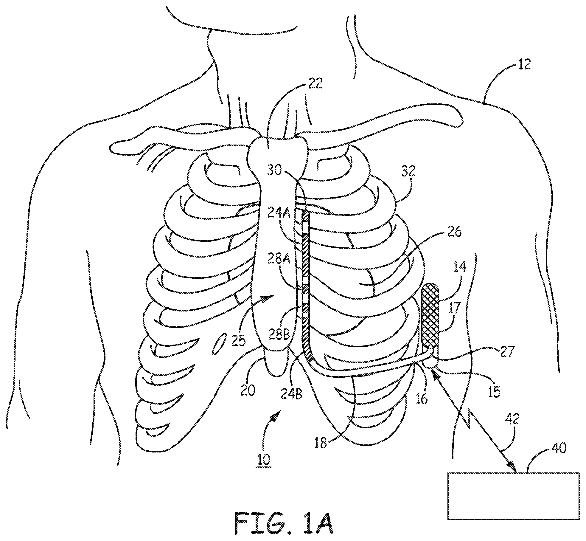 Patent US12157009 Figure 1 – Extra-cardiovascular pacing by an implantable cardioverter defibrillator