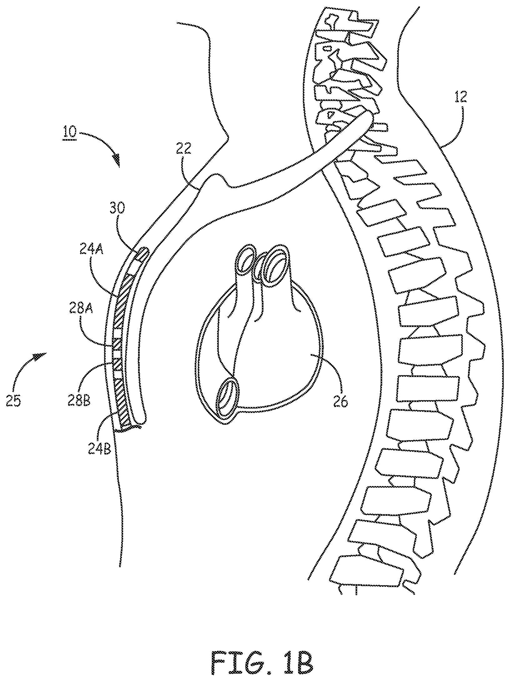Patent US12157009 Figure 2 – Extra-cardiovascular pacing by an implantable cardioverter defibrillator
