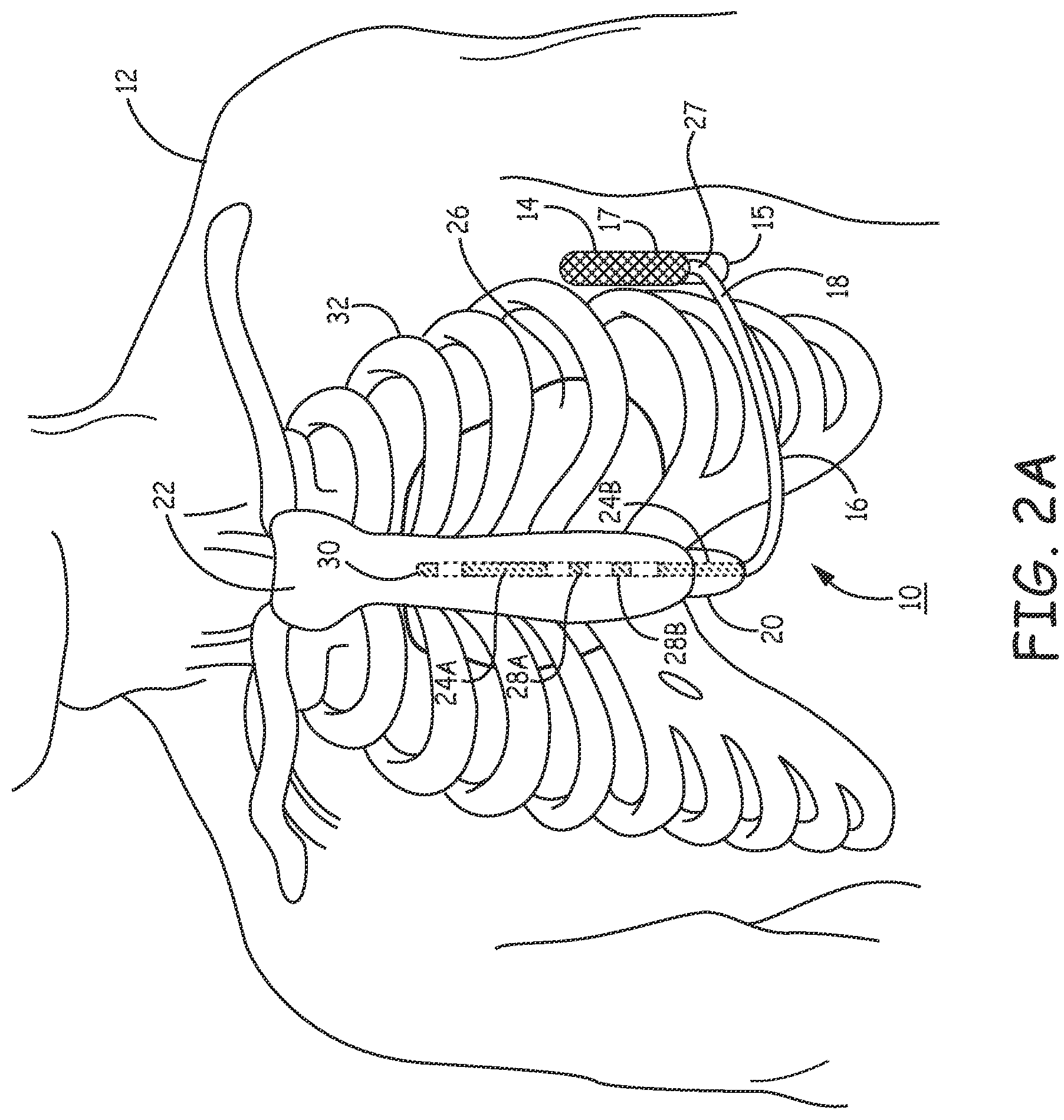 Patent US12157009 Figure 3 – Extra-cardiovascular pacing by an implantable cardioverter defibrillator