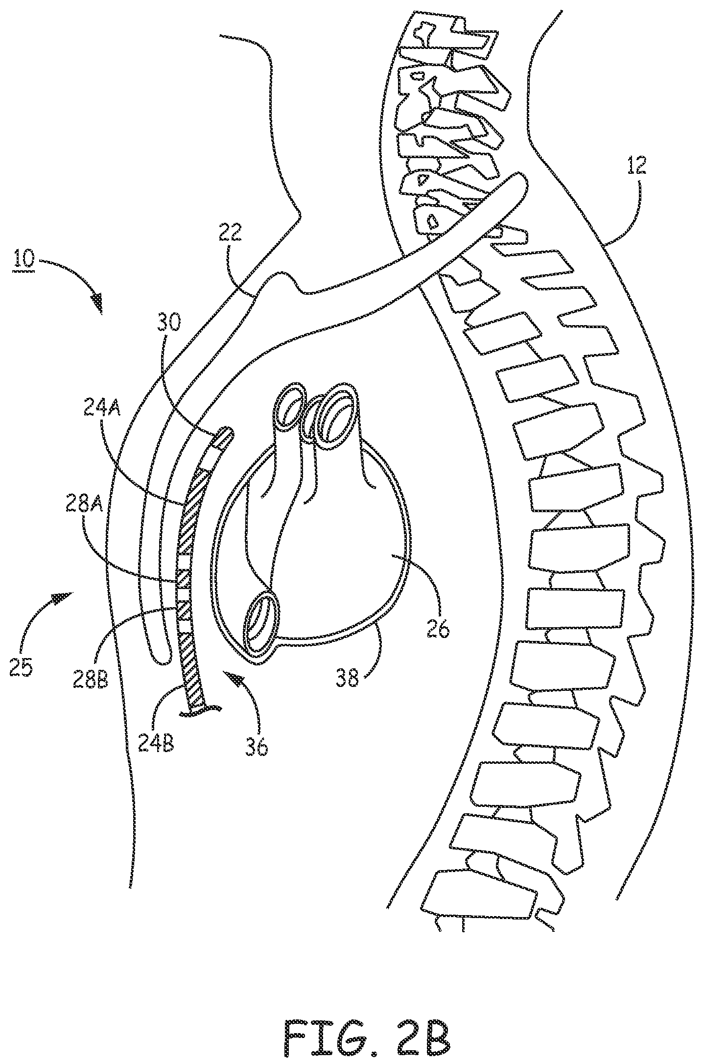 Patent US12157009 Figure 4 – Extra-cardiovascular pacing by an implantable cardioverter defibrillator
