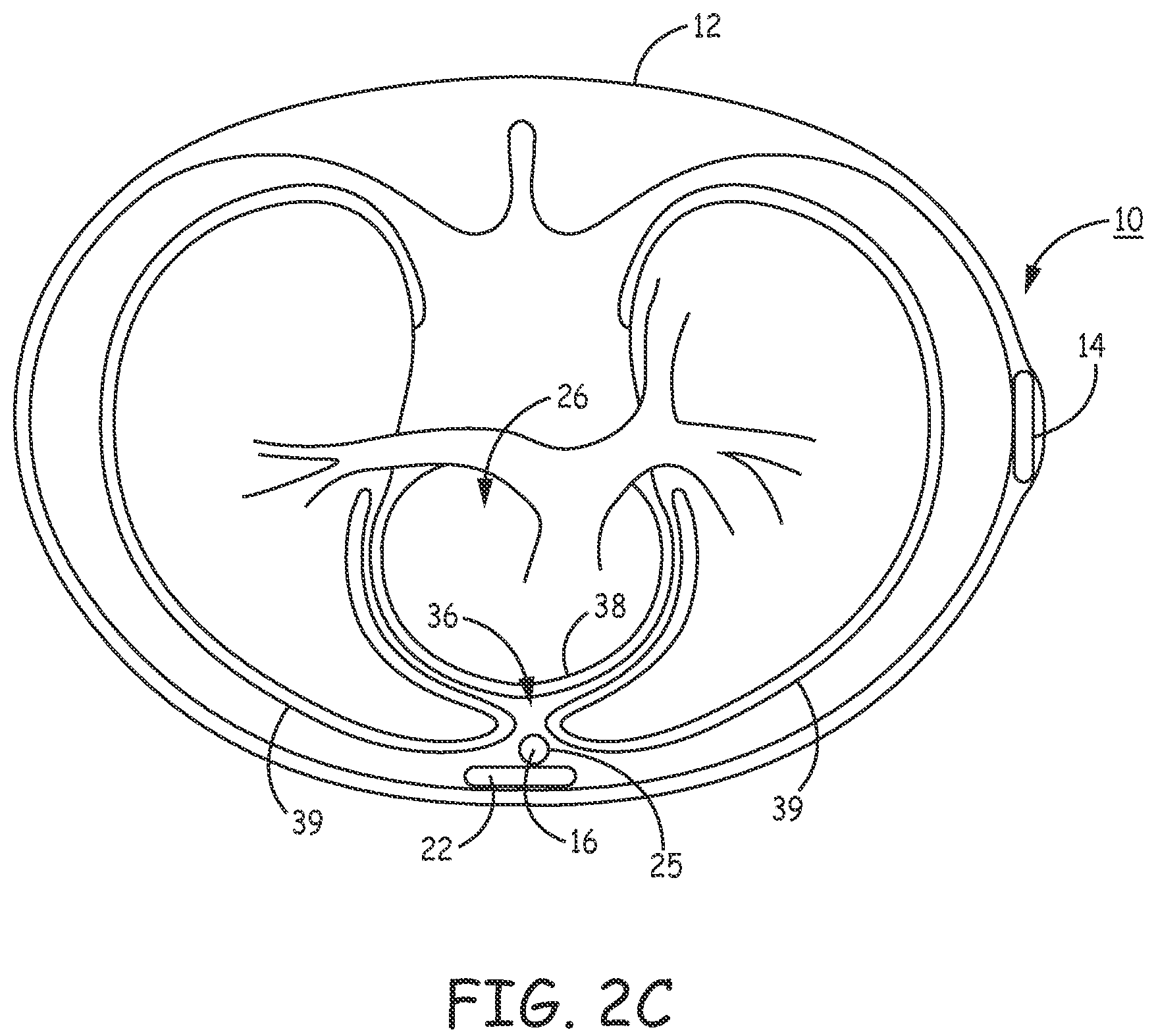 Patent US12157009 Figure 5 – Extra-cardiovascular pacing by an implantable cardioverter defibrillator