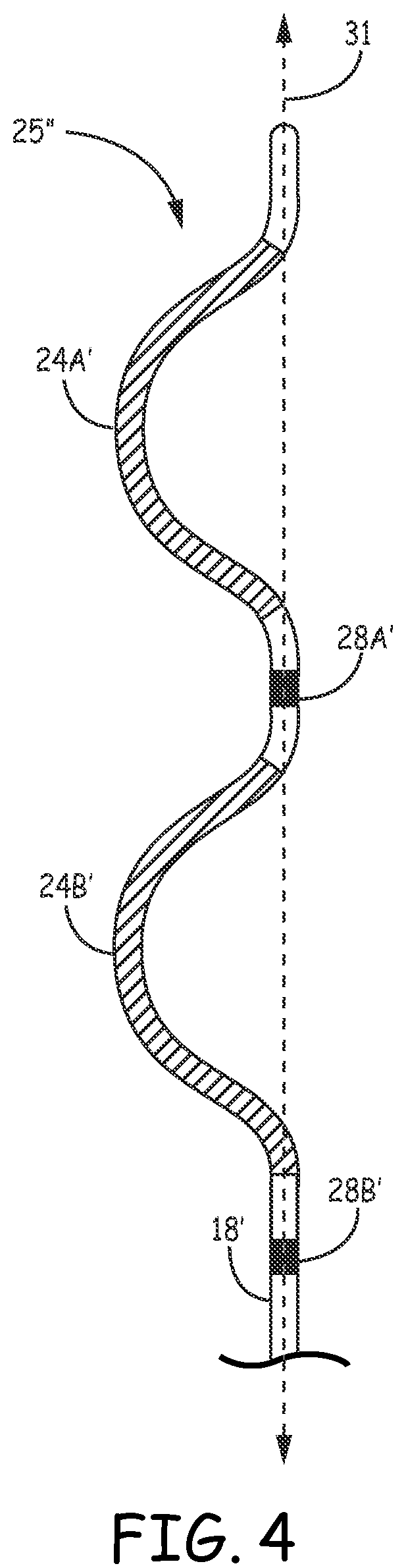 Patent US12157009 Figure 7 – Extra-cardiovascular pacing by an implantable cardioverter defibrillator