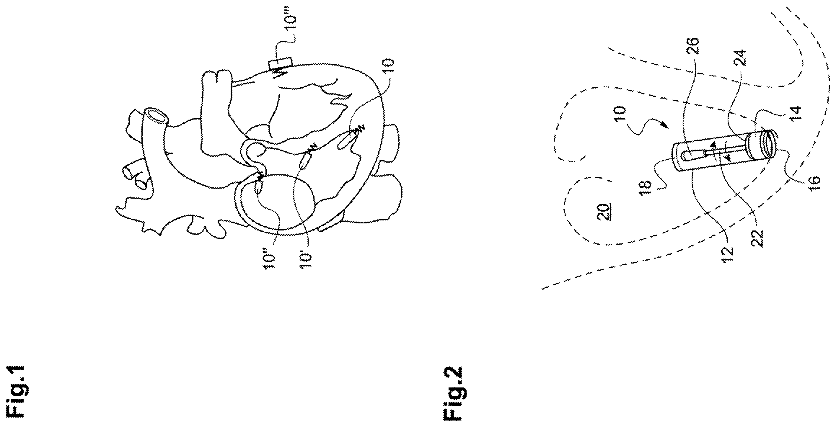 Patent US12157010 Figure 1 – Energy harvesting module with compact-construction piezoelectric transducer, in particular for powering a leadless autonomous cardiaccapsule