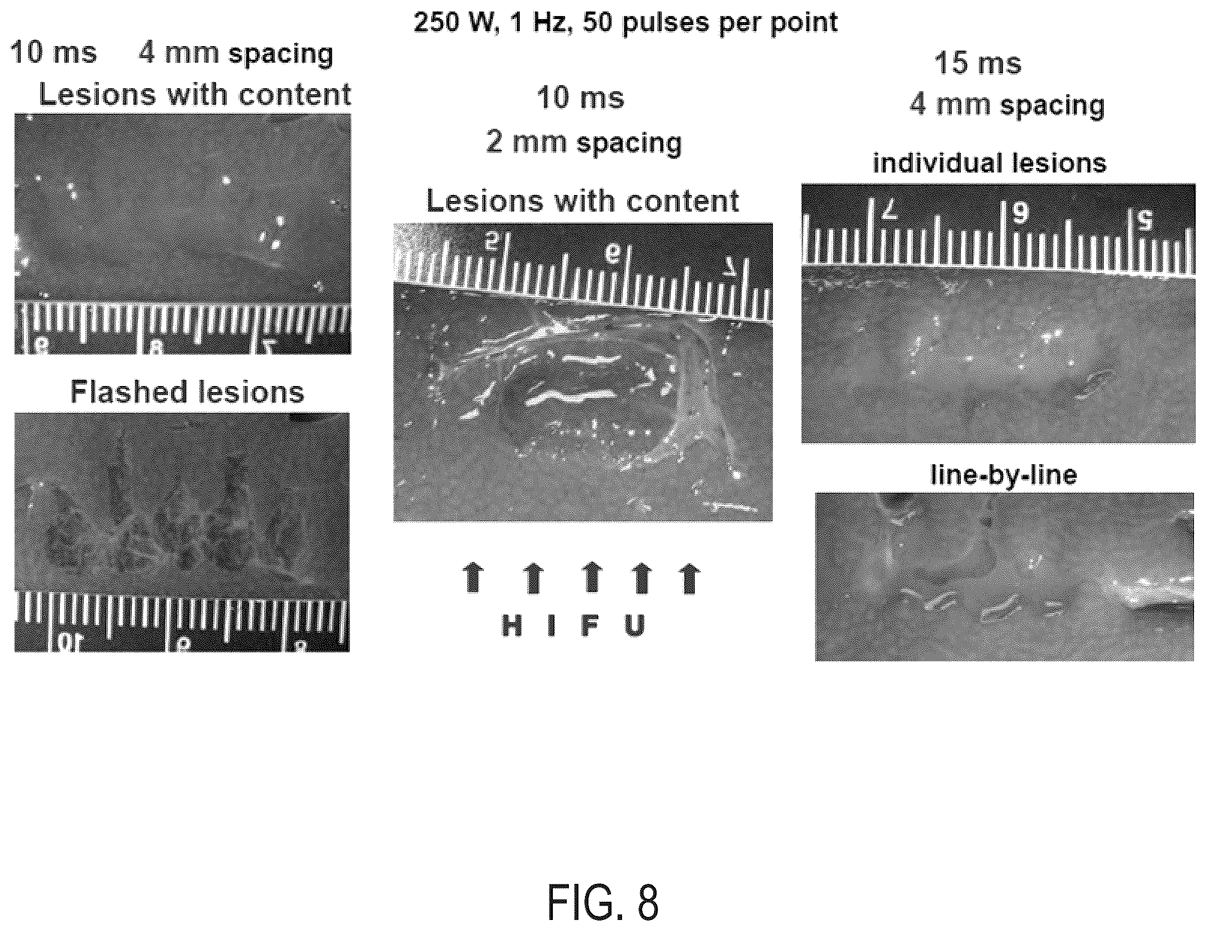 Patent US12157018 Figure 10 – Boiling histotripsy methods and systems for uniform volumetric ablation of an object by high-intensity focused ultrasound waves with shocks