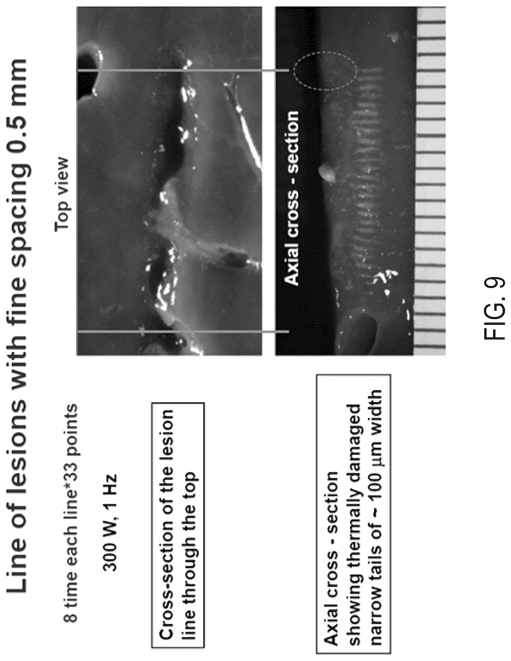 Patent US12157018 Figure 11 – Boiling histotripsy methods and systems for uniform volumetric ablation of an object by high-intensity focused ultrasound waves with shocks